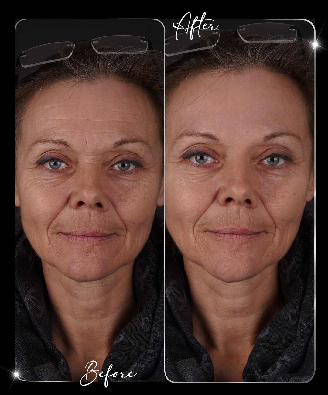 Botox-Before-After-1