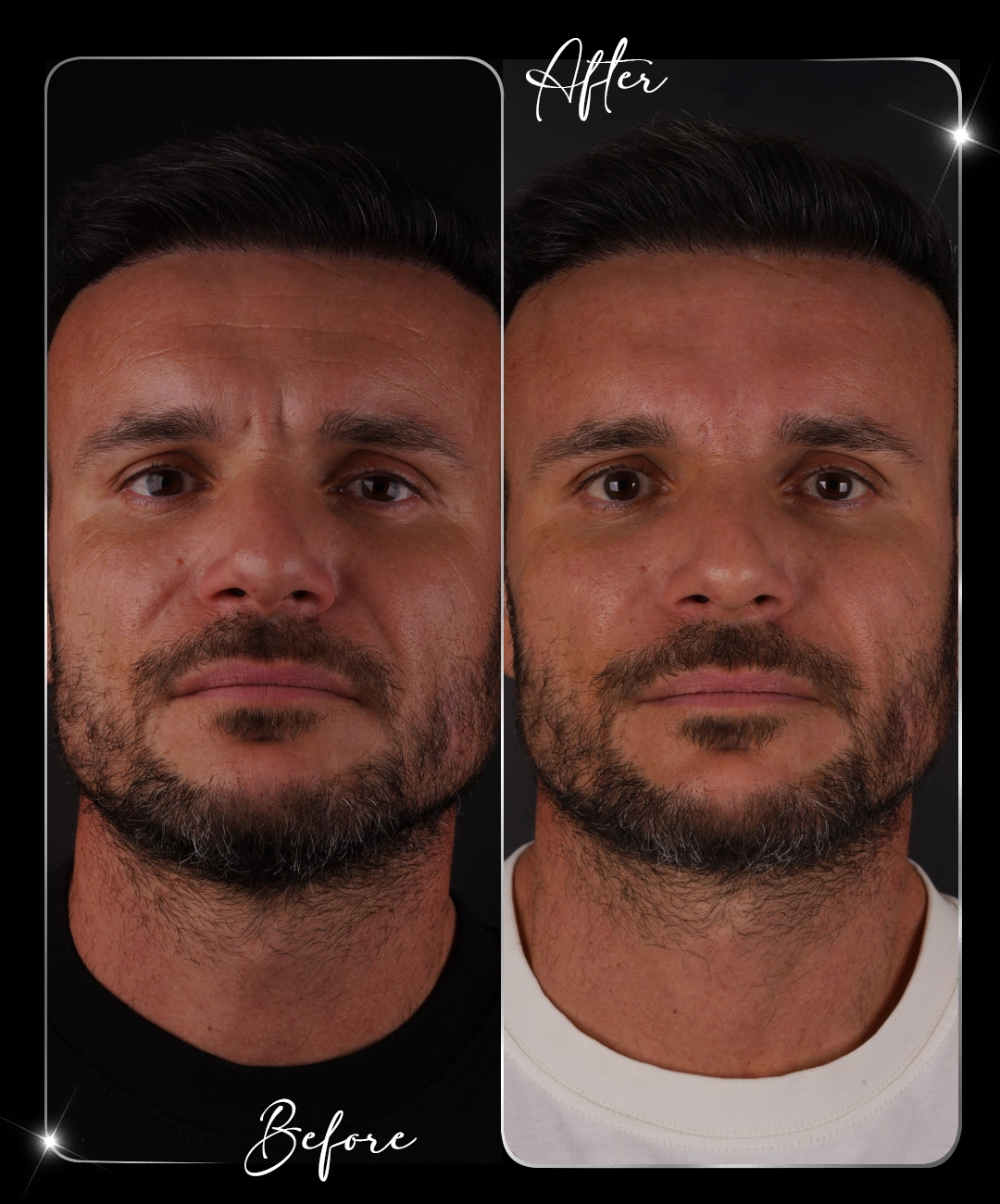 Botox-Before-After-2