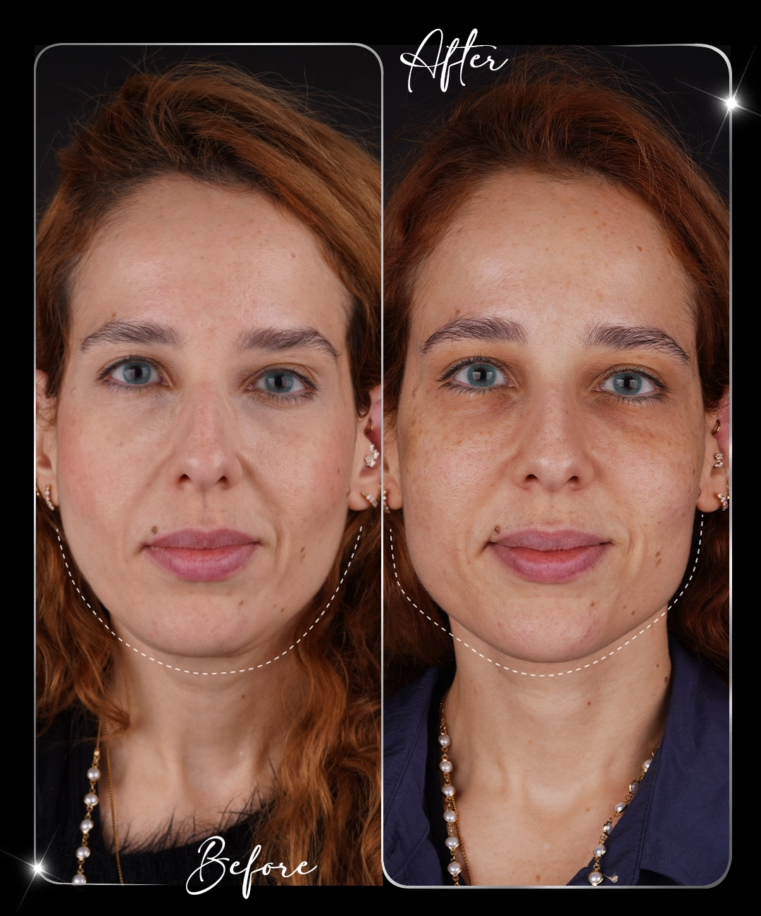 Botox-Before-After-3