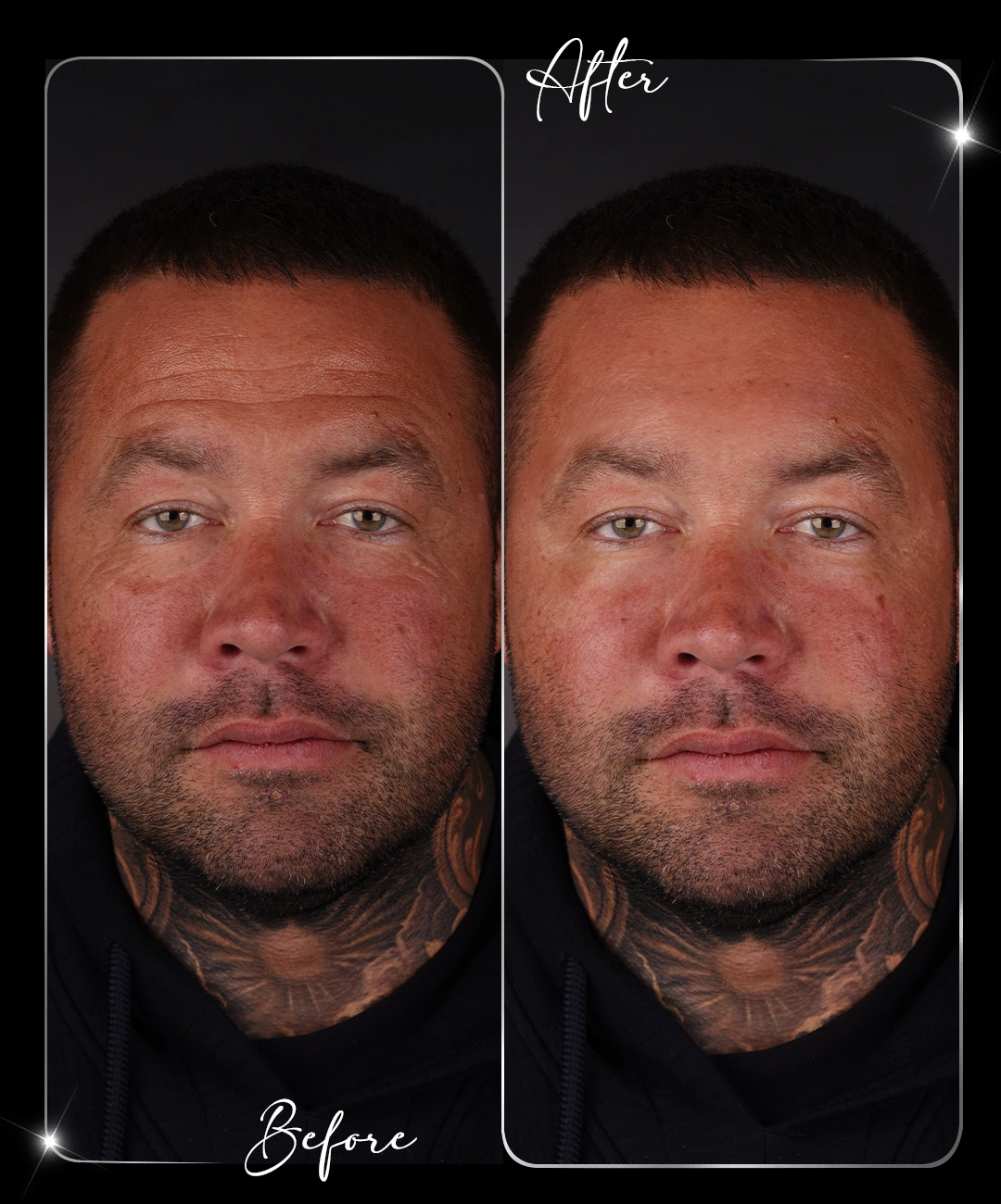 Botox-Before-After-4