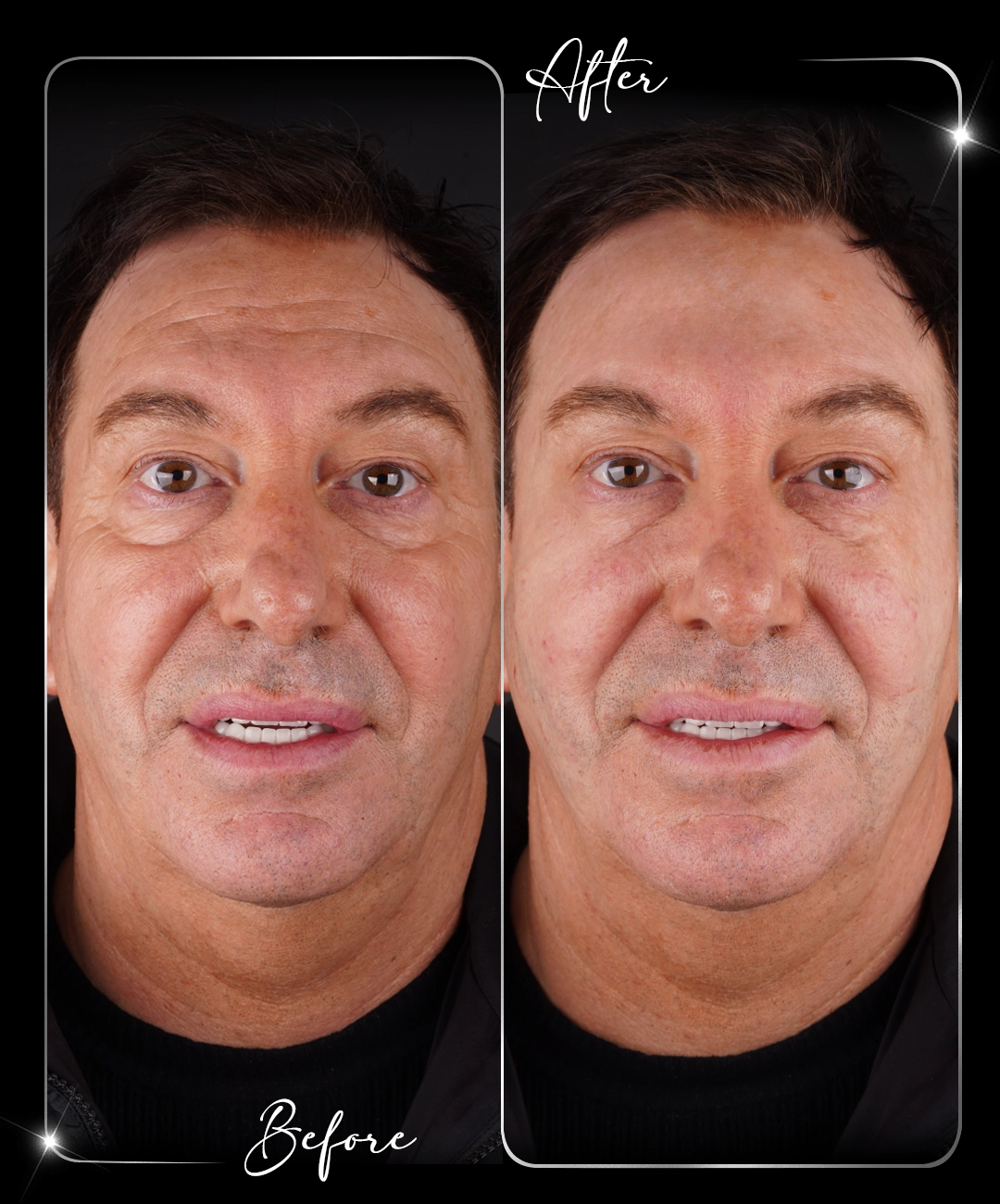 Botox-Before-After-5