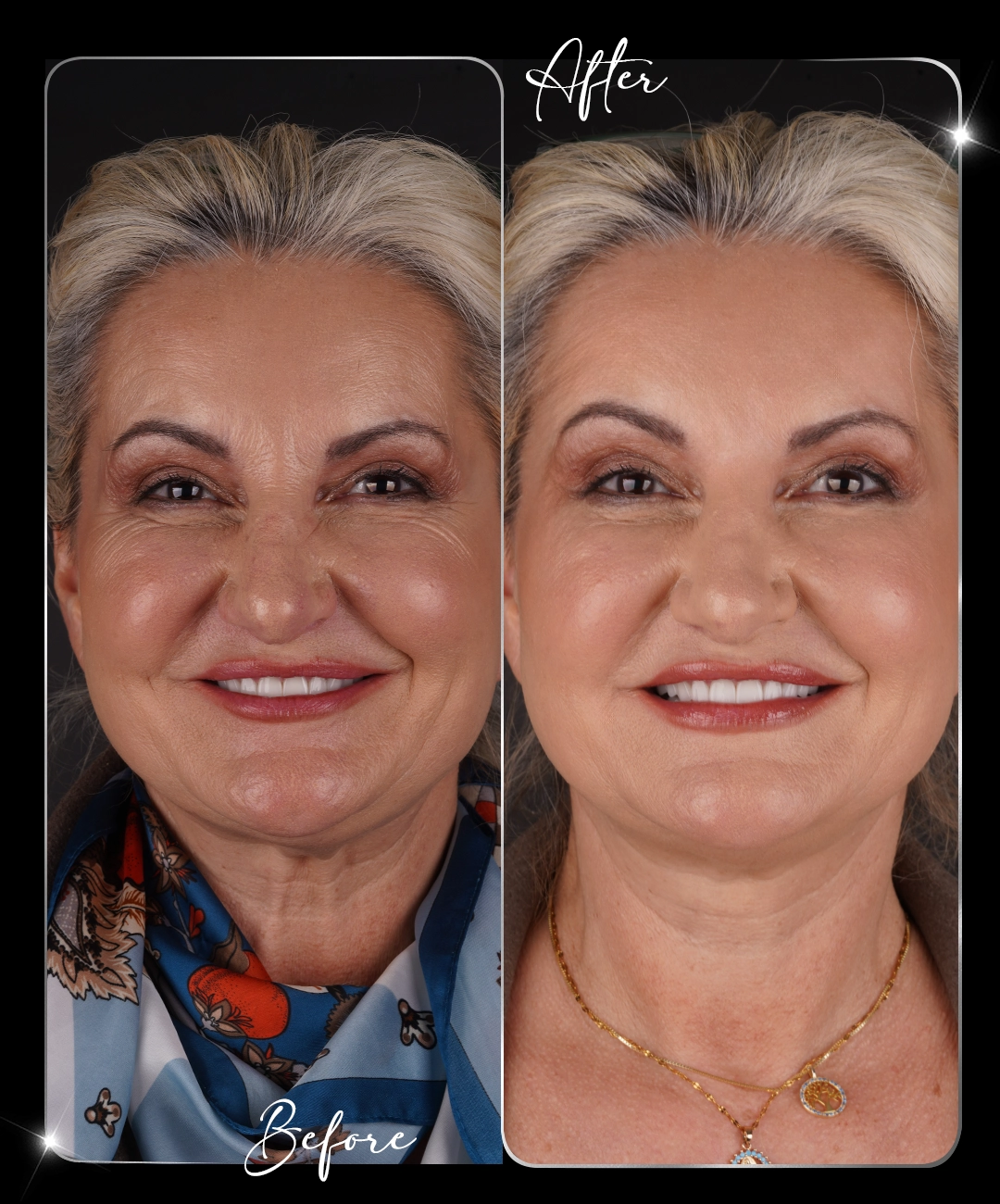 Botox-Before-After-6
