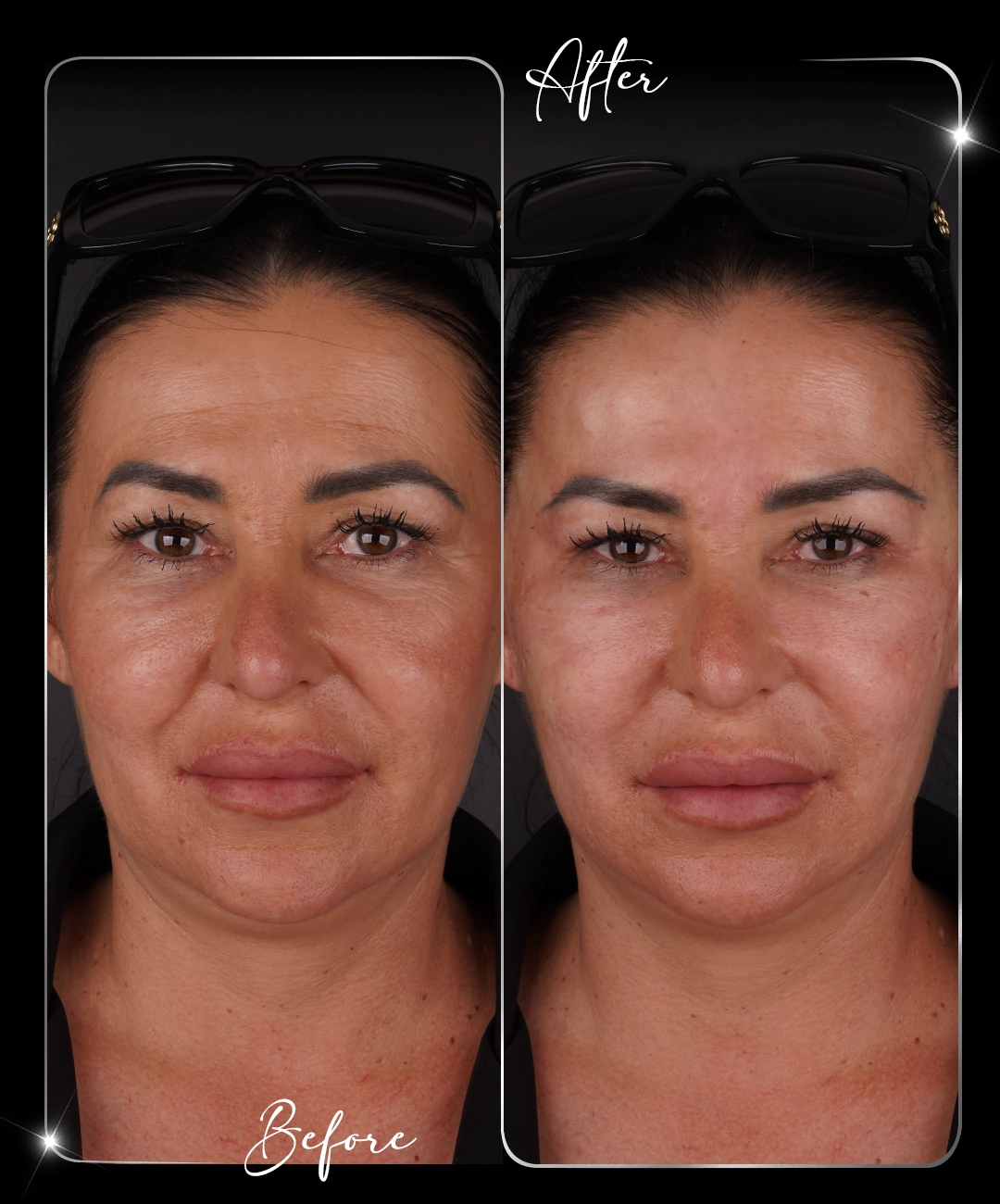Botox-Before-After-7