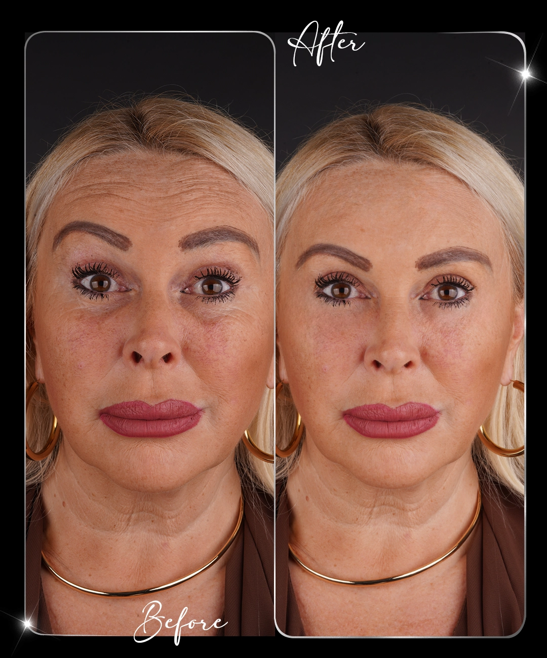 Botox-After-8