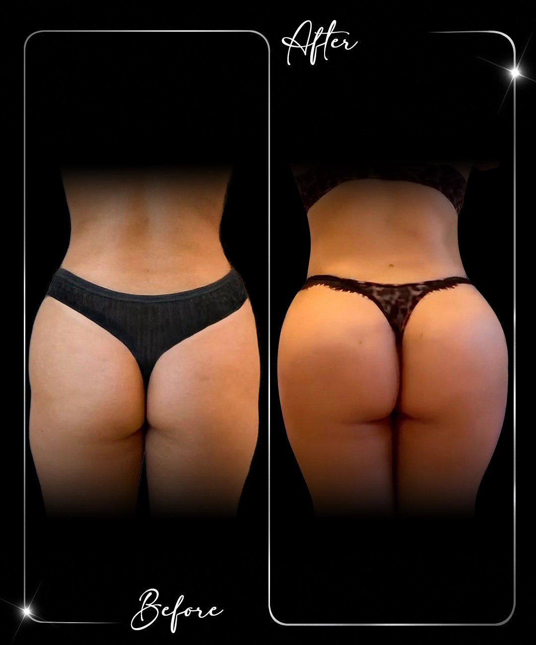 Brazilian-Butt-Lift-Before-After-10