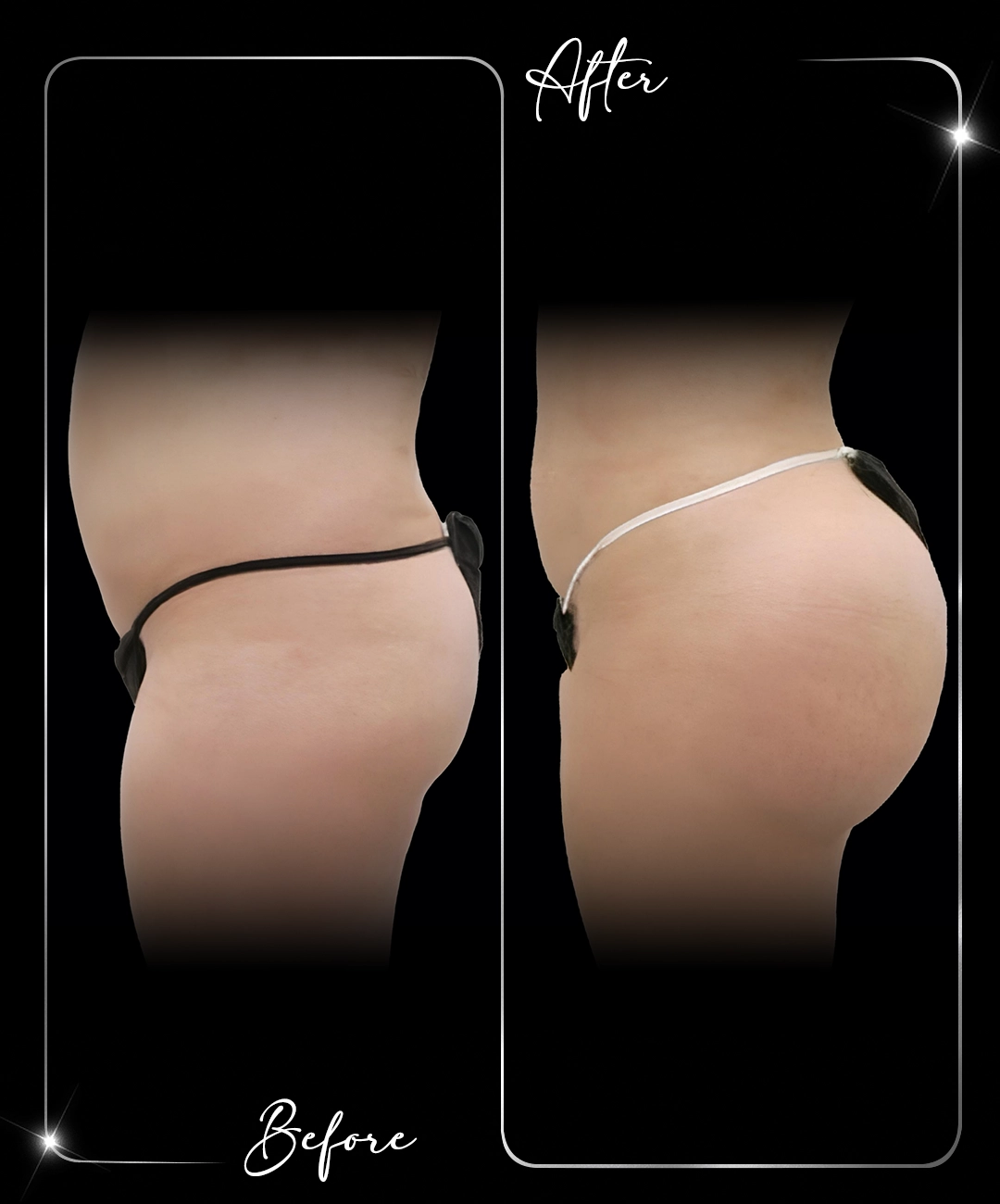 Brazilian-Butt-Lift-Before-After-2