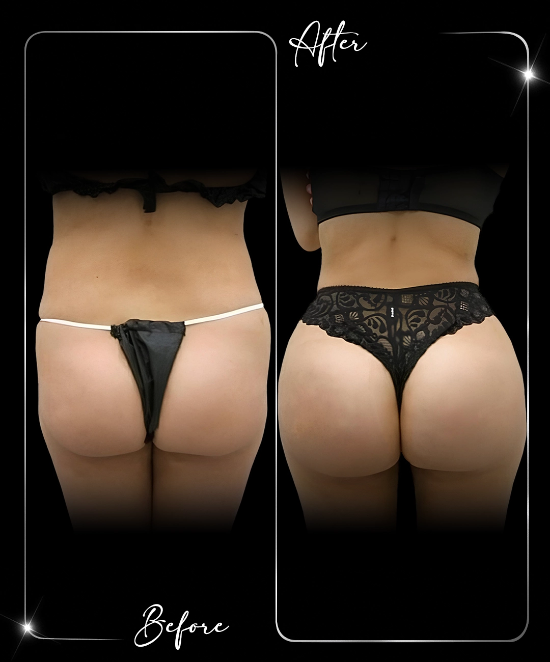 Brazilian-Butt-Lift-Before-After-3