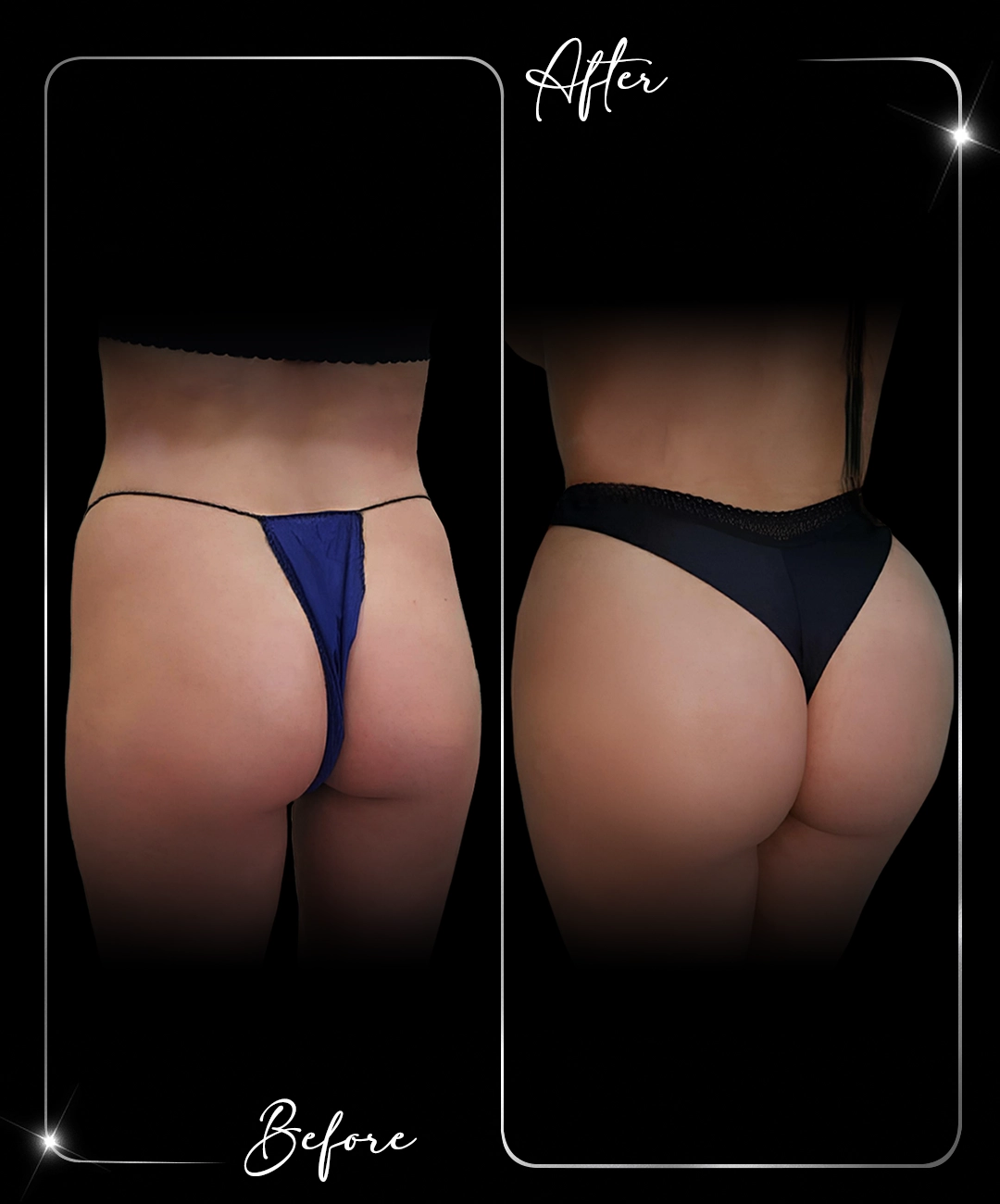 Brazilian-Butt-Lift-Before-After-5