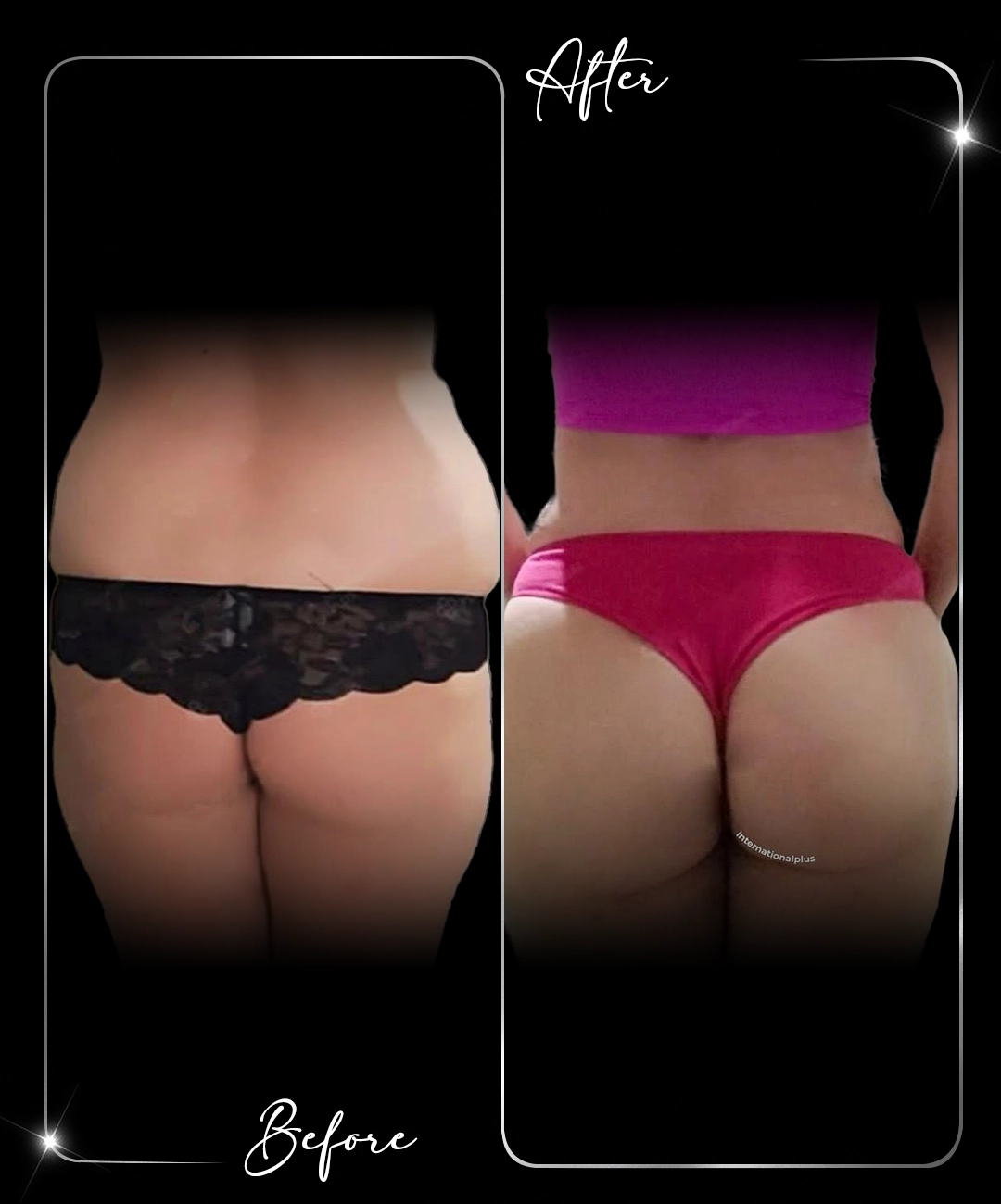 Brazilian-Butt-Lift-Before-After-6