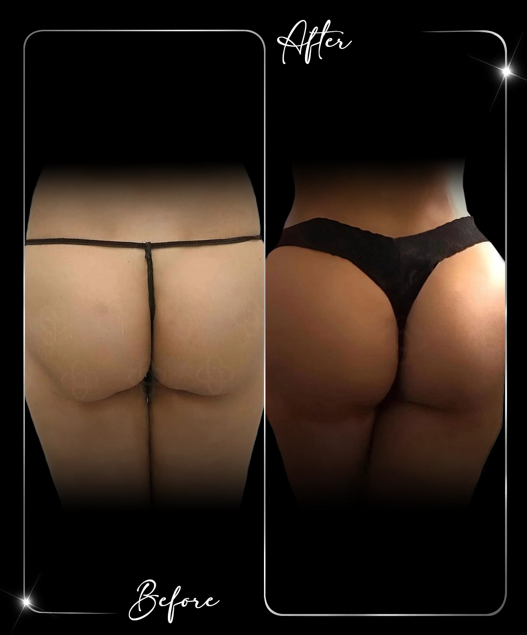 Brazilian-Butt-Lift-Before-After-7