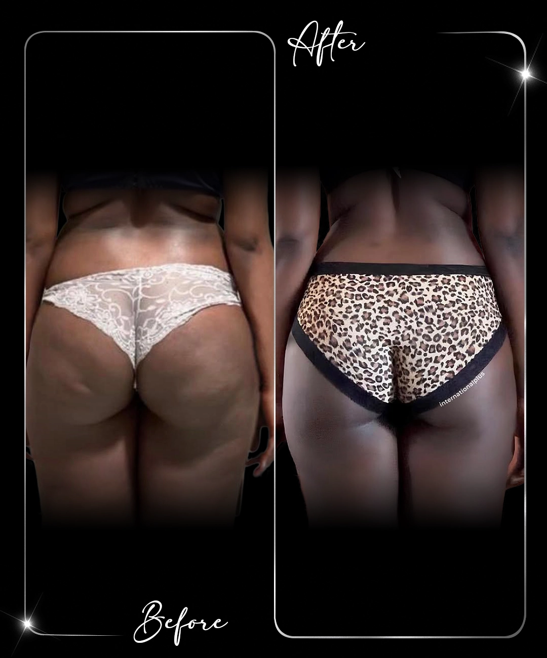 Brazilian-Butt-Lift-Before-After-8