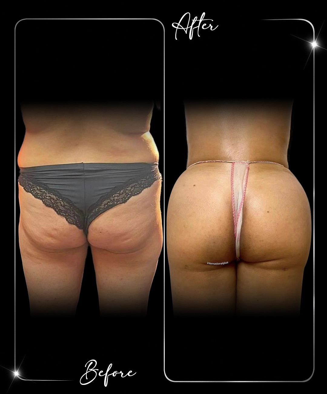 Brazilian-Butt-Lift-Before-After-9