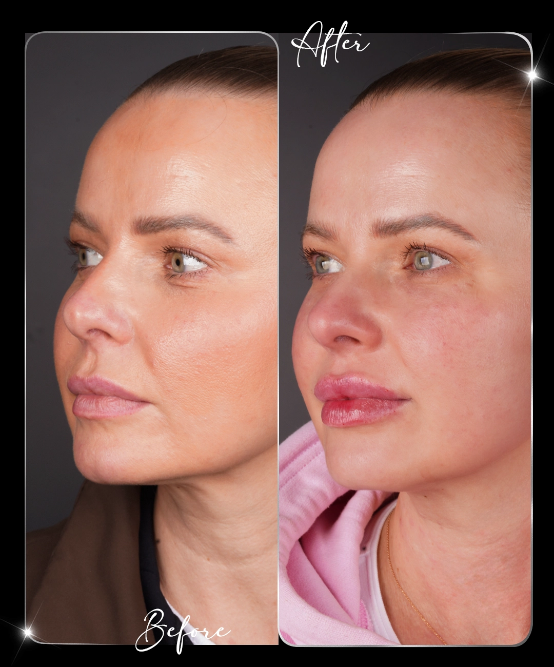 Filler-Before-After-10
