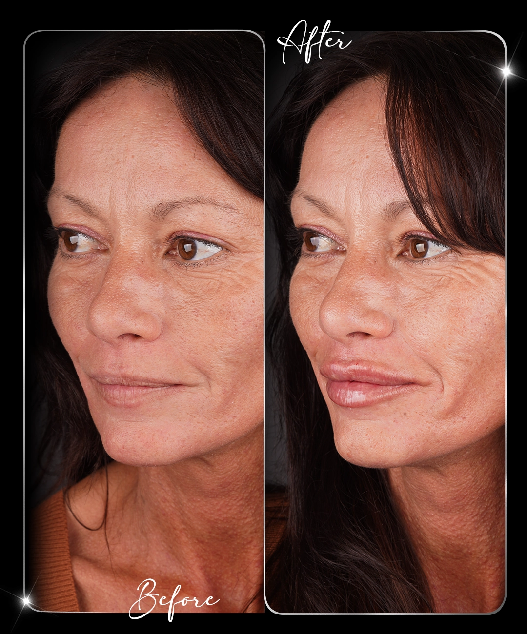 Filler-Before-After-1