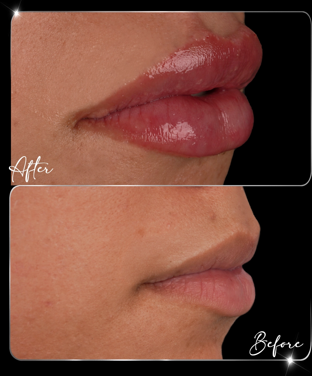 Filler-Before-After-2