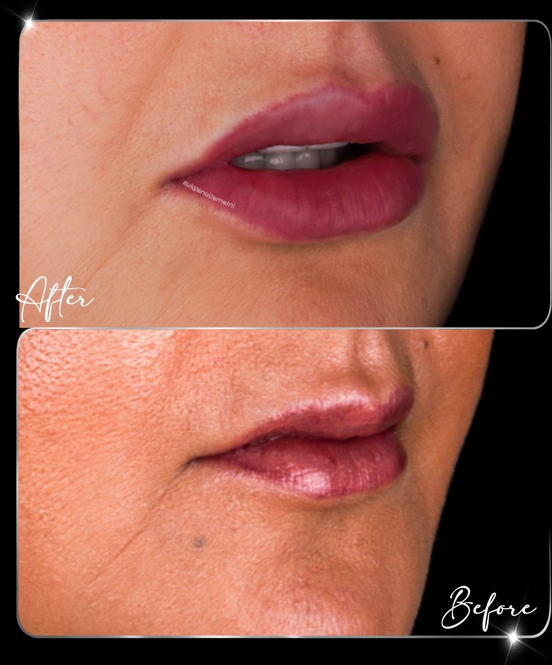 Filler-Before-After-3