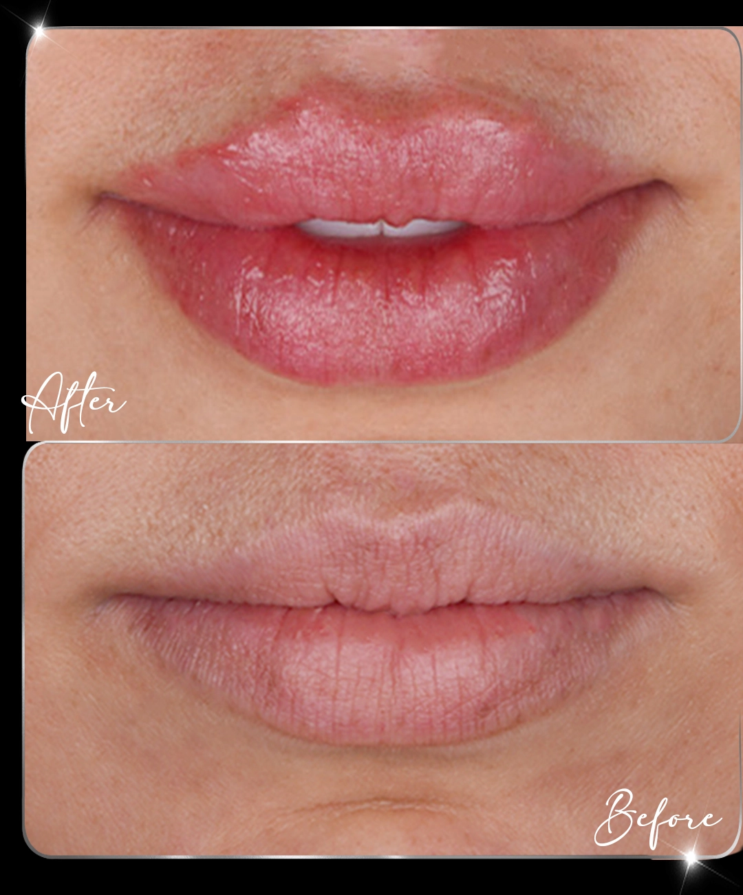 Filler-Before-After-4