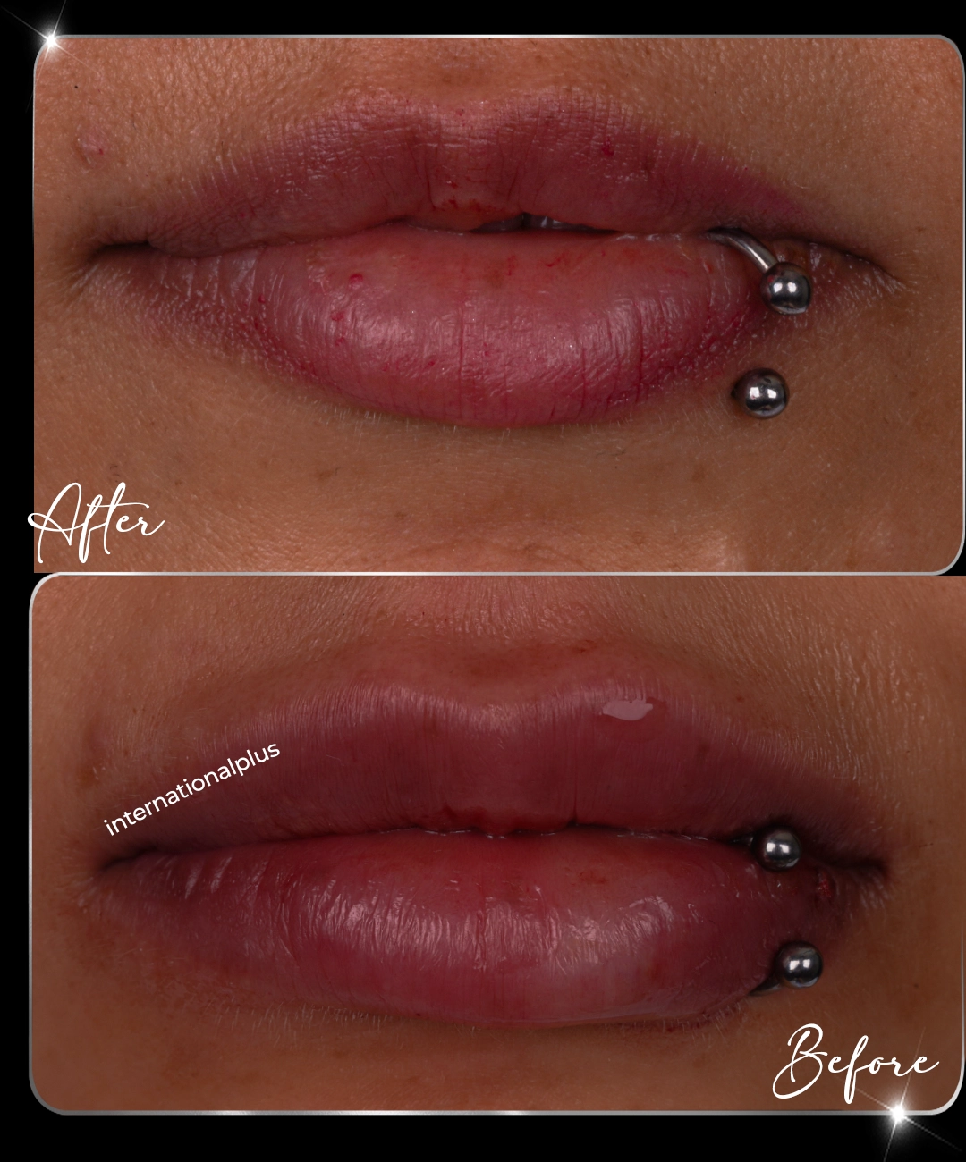Filler-Before-After-5