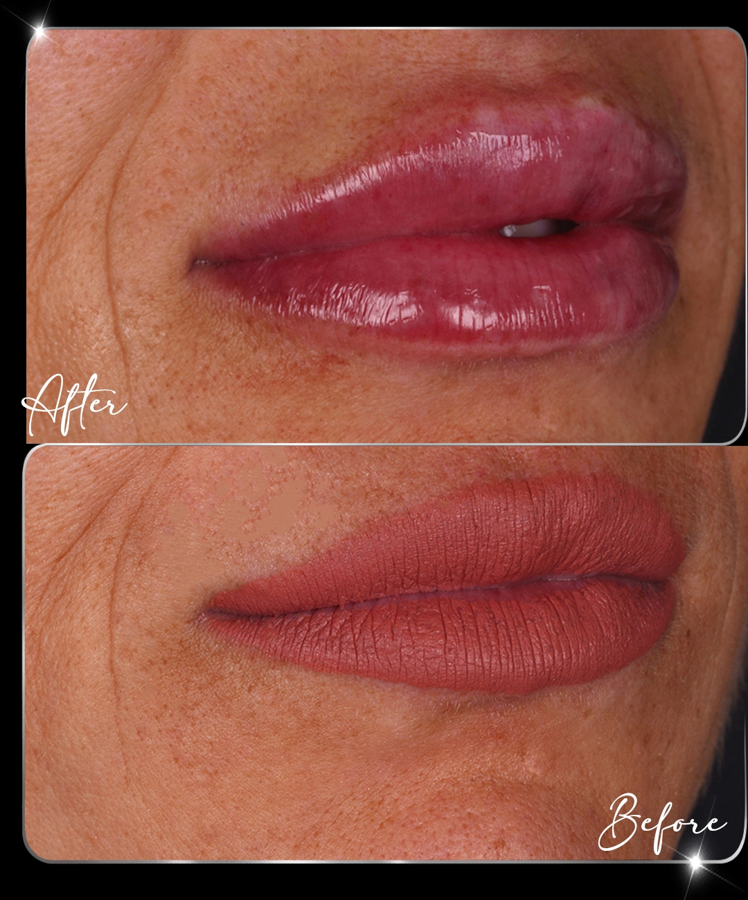 Filler-Before-After-6