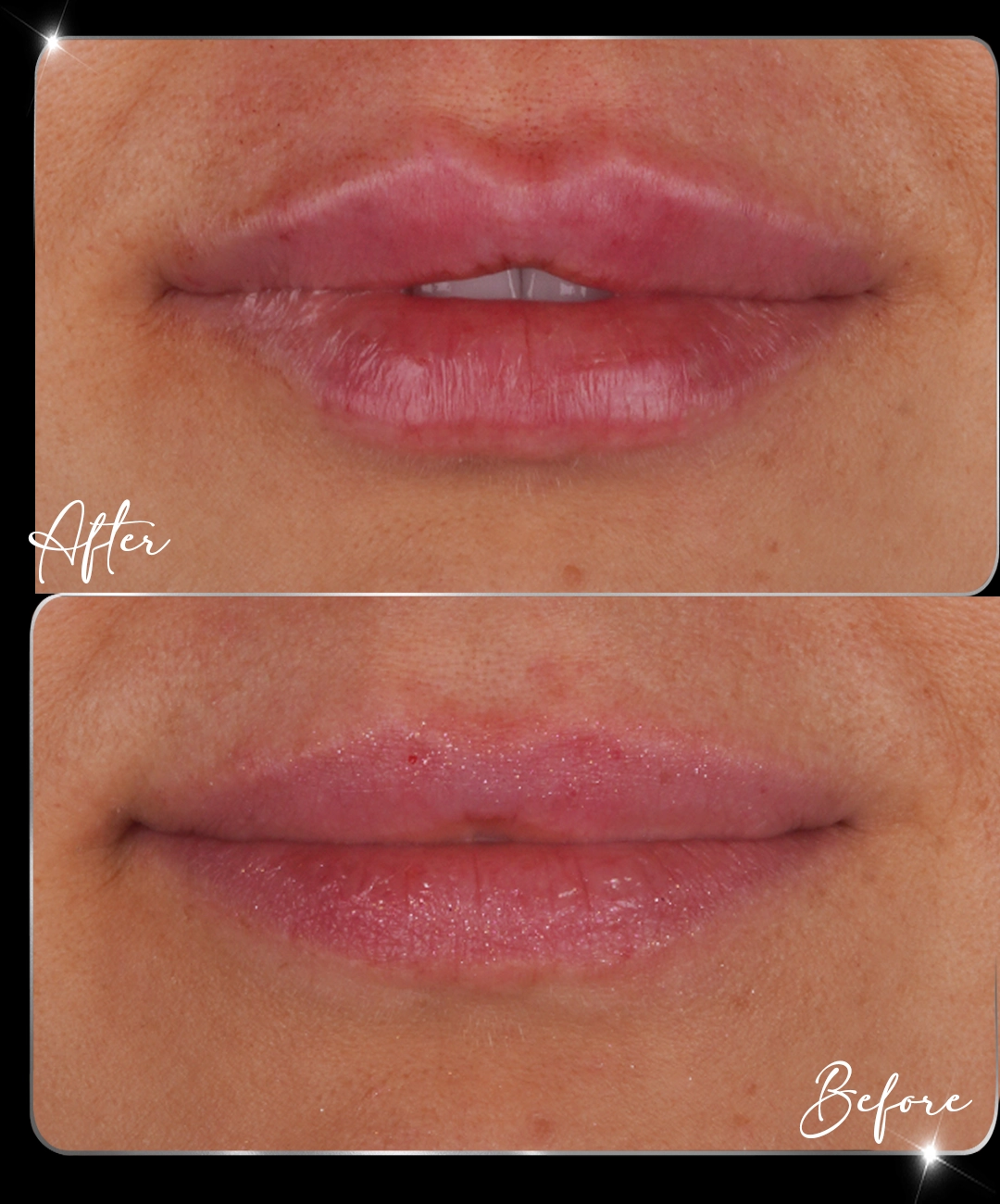 Filler-Before-After-7