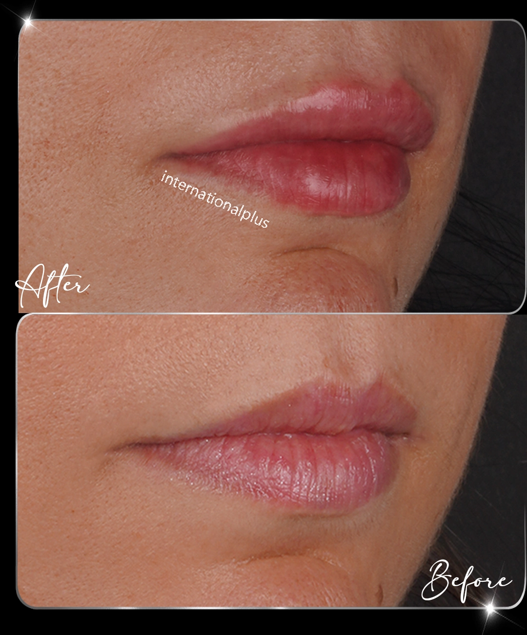 Filler-Before-After-8