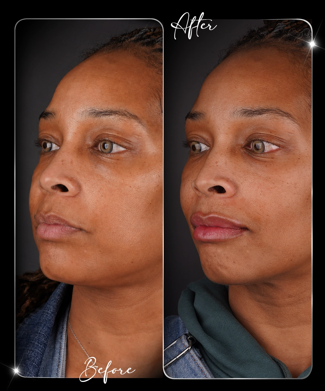 Filler-Before-After-9