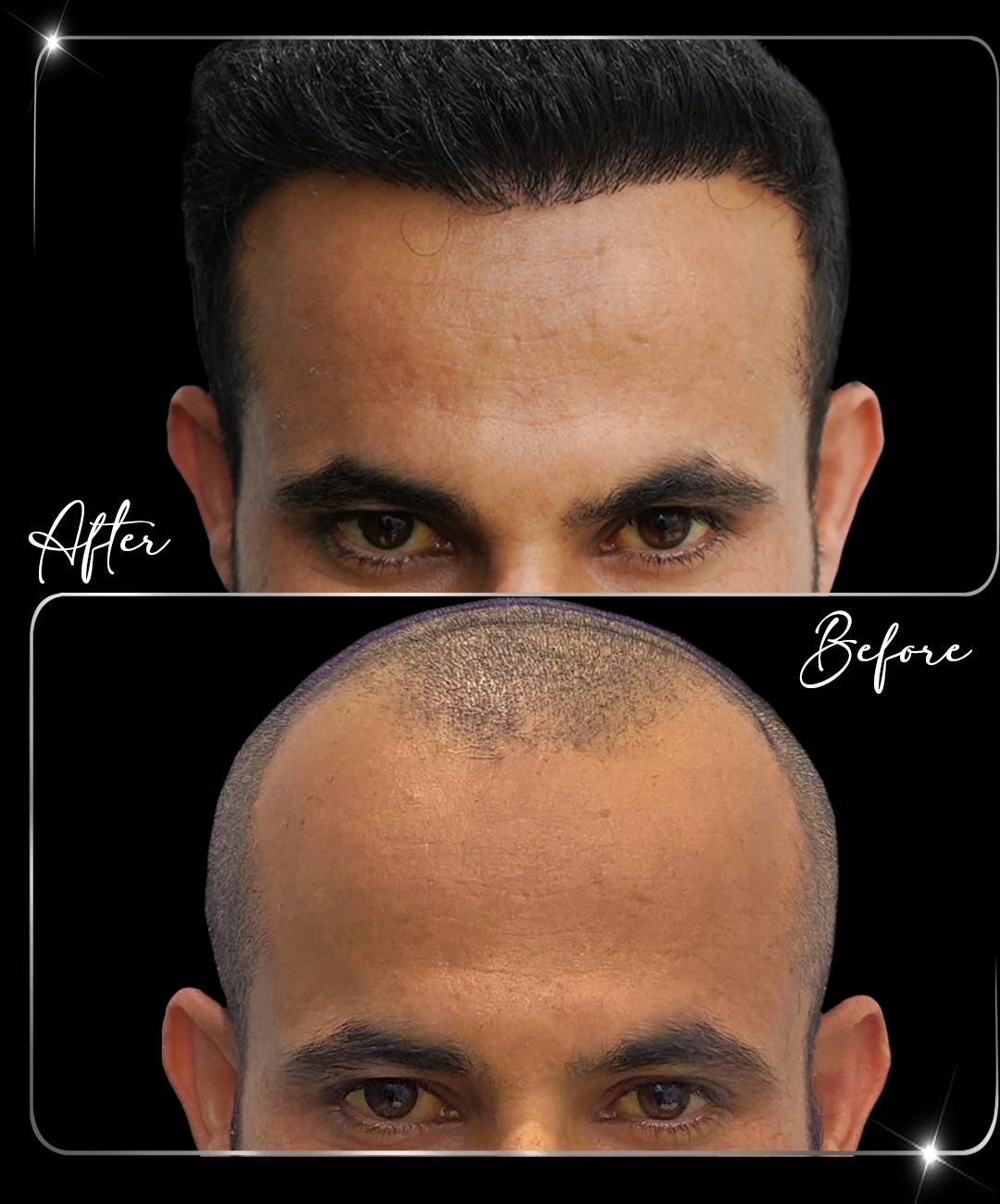 Hair-Transplant-Before-After-1