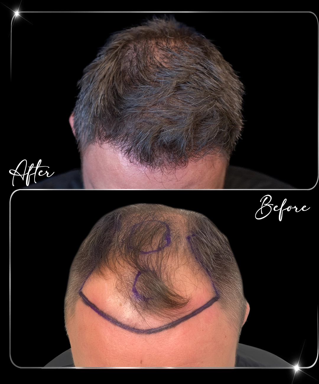 Hair-Transplant-Before-After-10