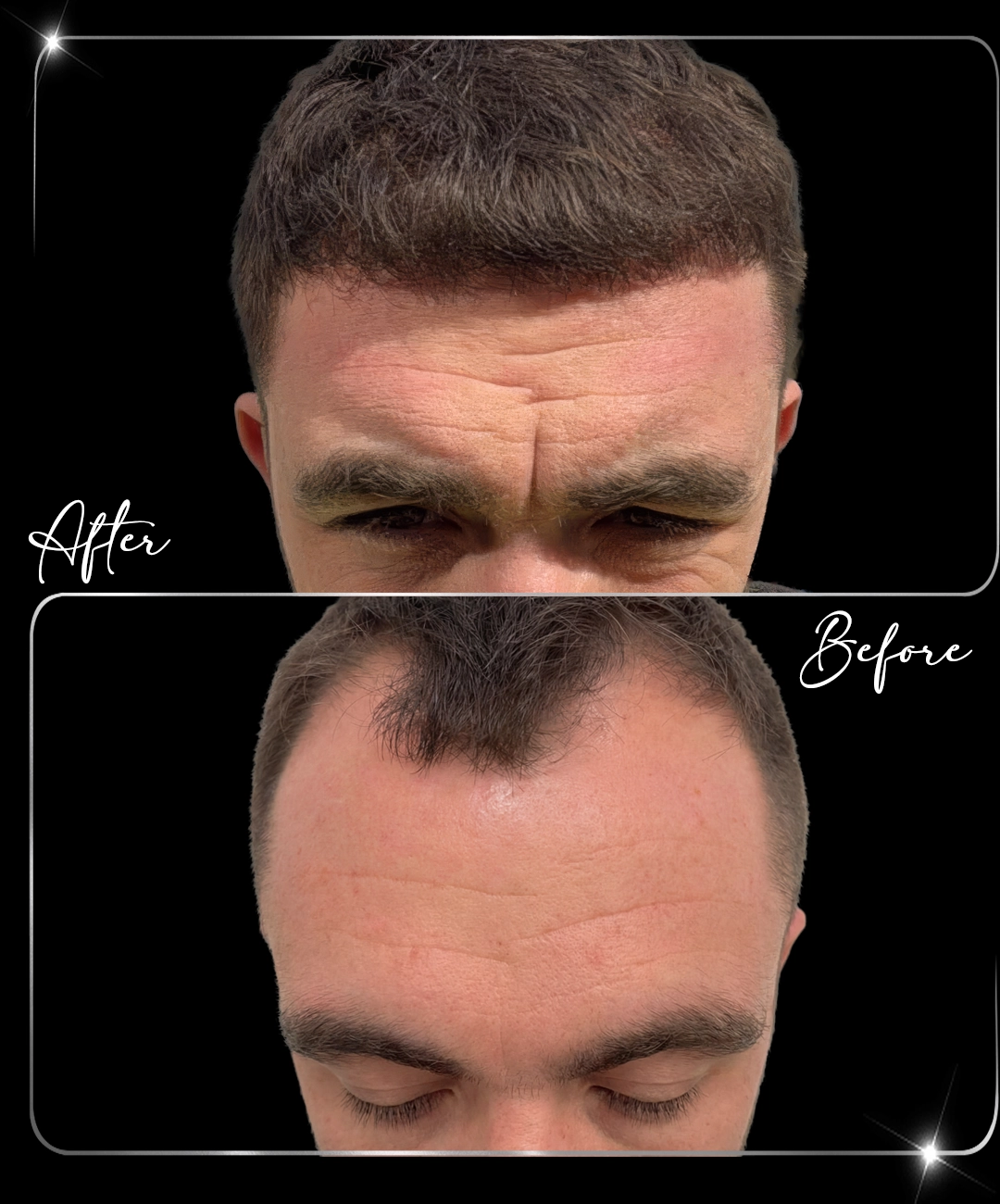Hair-Transplant-Before-After-2