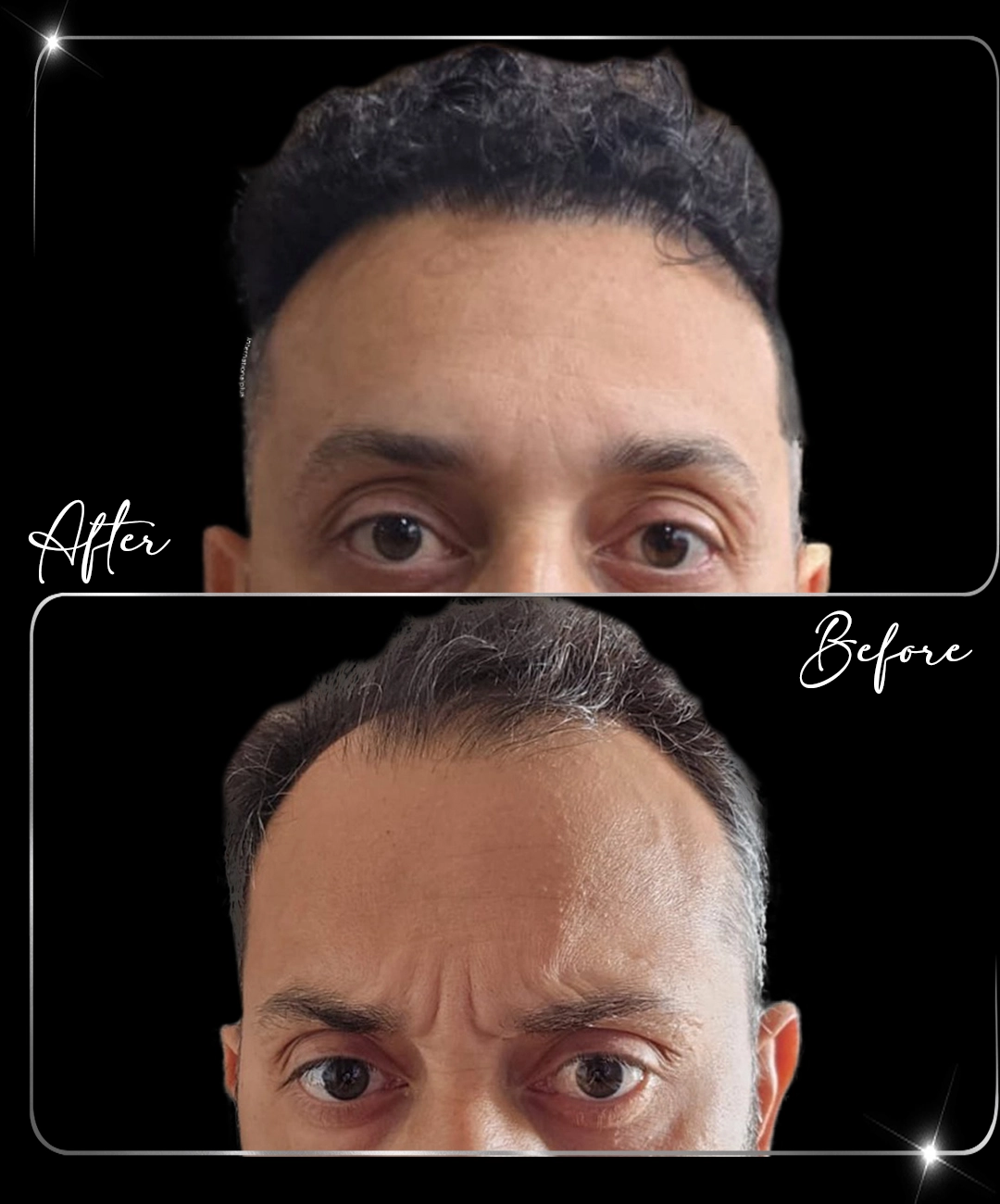 Hair-Transplant-Before-After-3