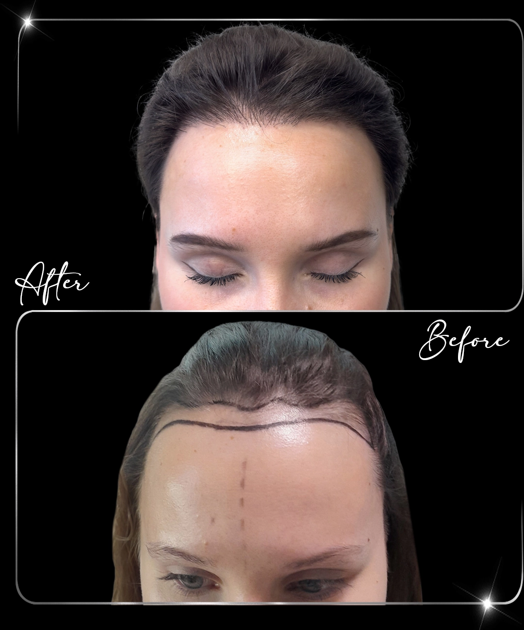 Hair-Transplant-Before-After-4