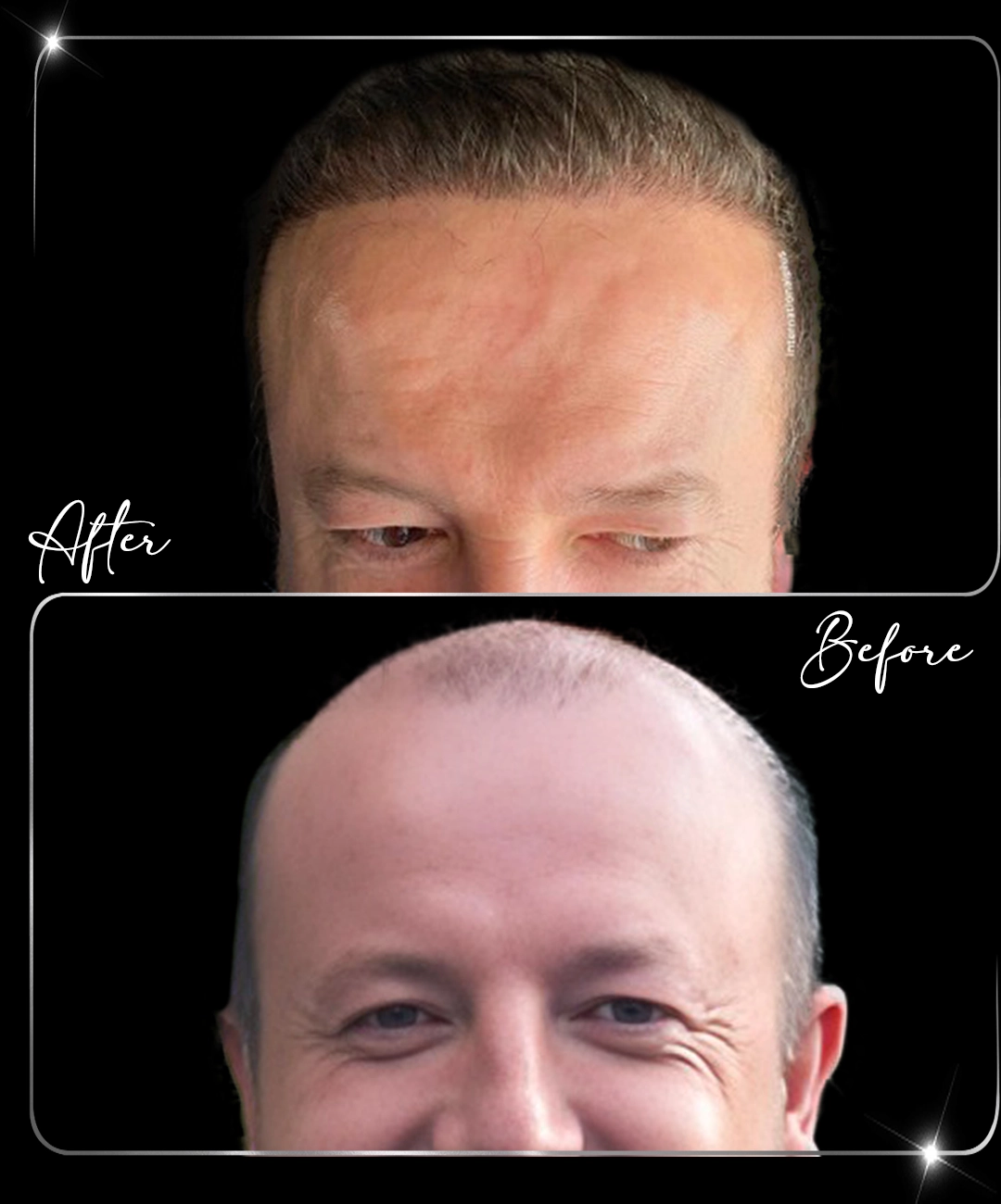 Hair-Transplant-Before-After-5