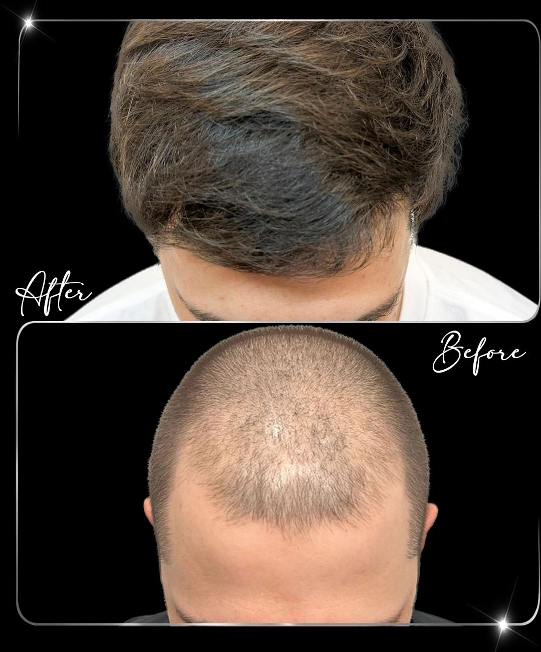 Hair-Transplant-Before-After-6