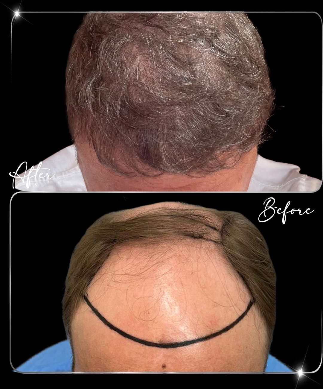 Hair-Transplant-Before-After-7