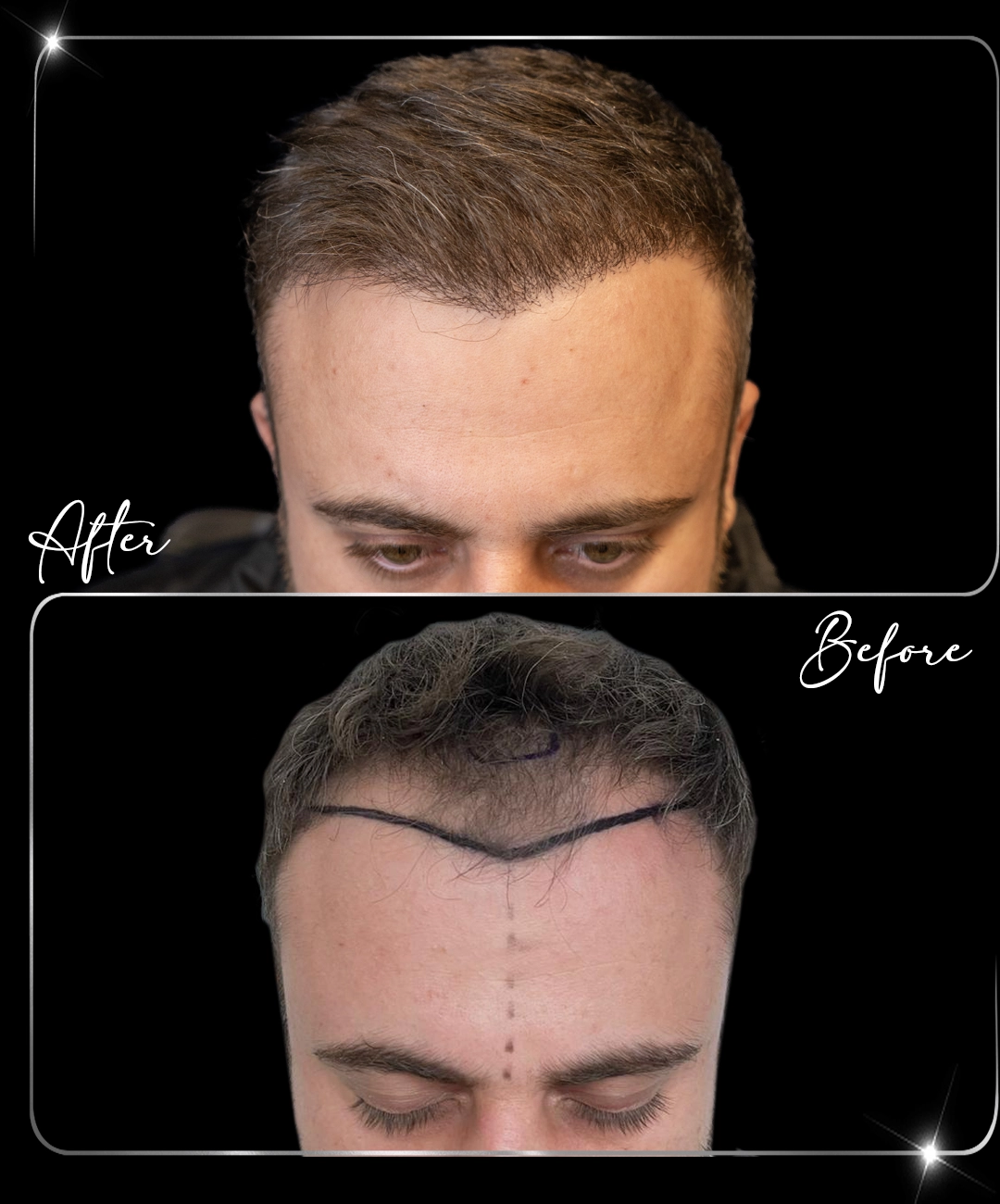Hair-Transplant-Before-After-8