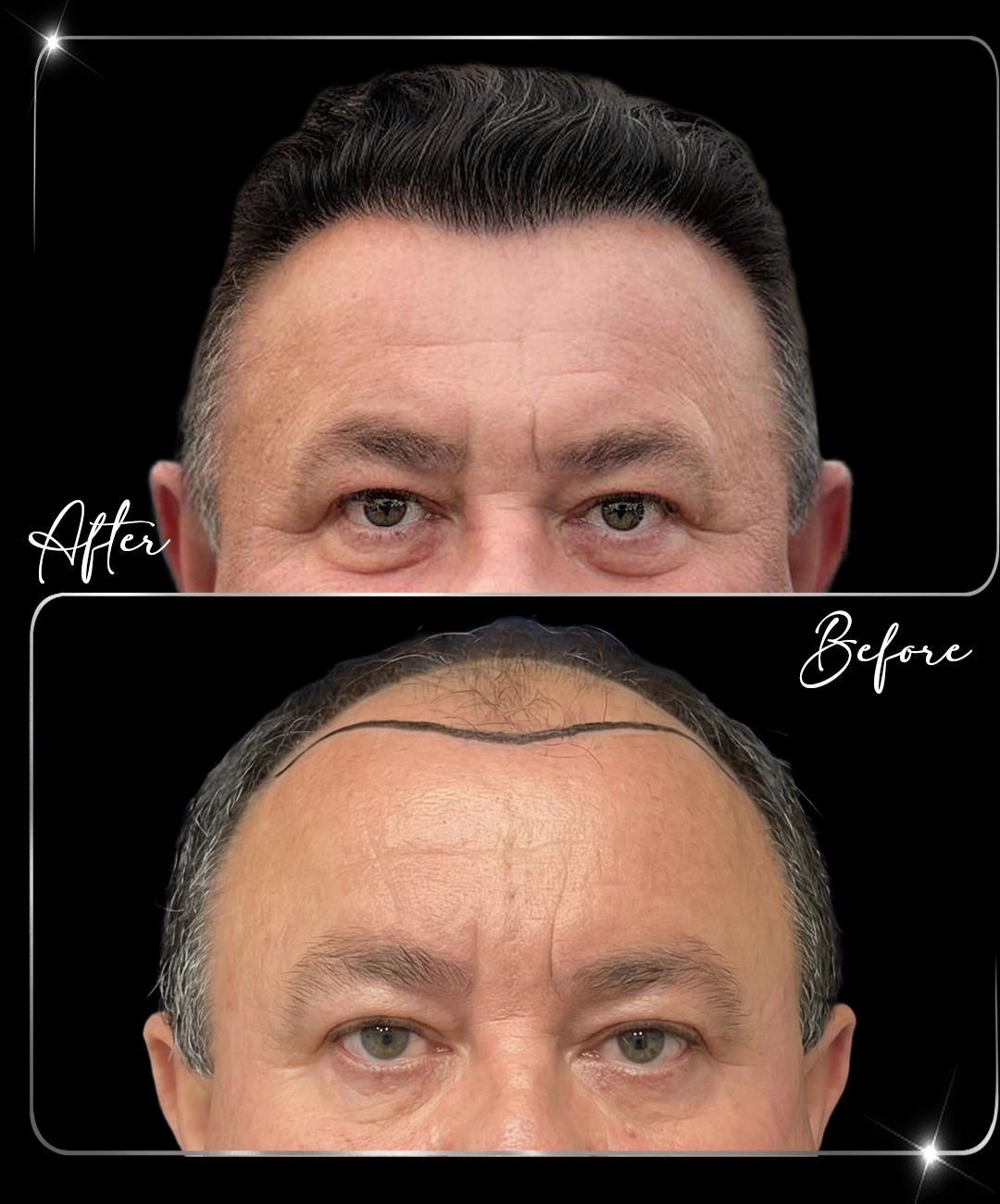 Hair-Transplant-Before-After-9
