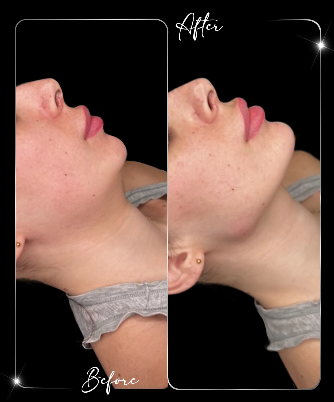 Jawline-Before-After-10