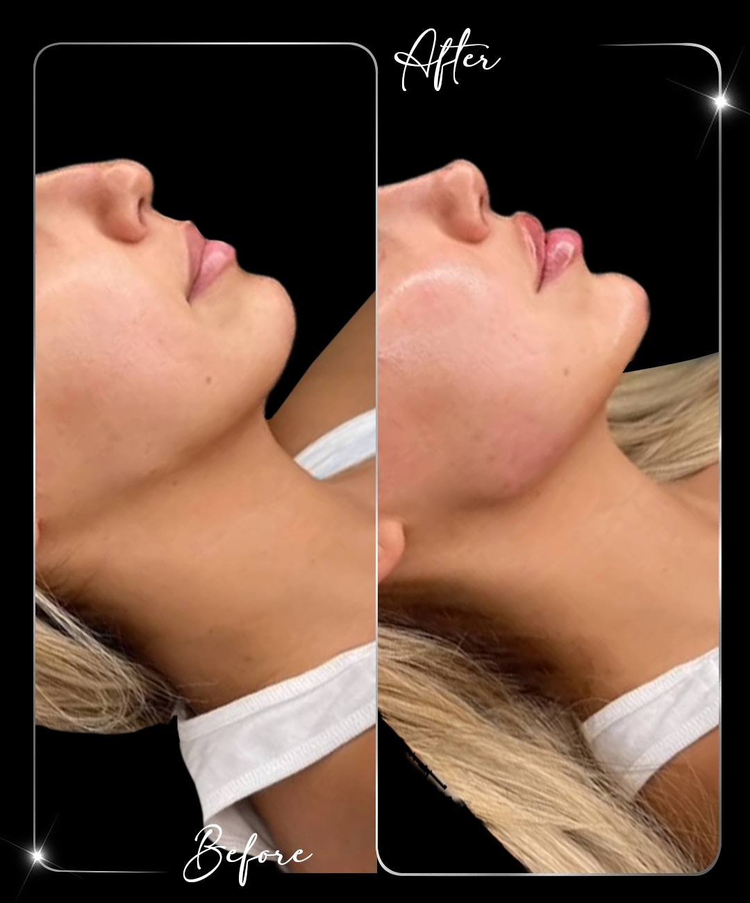 Jawline-Before-After-2