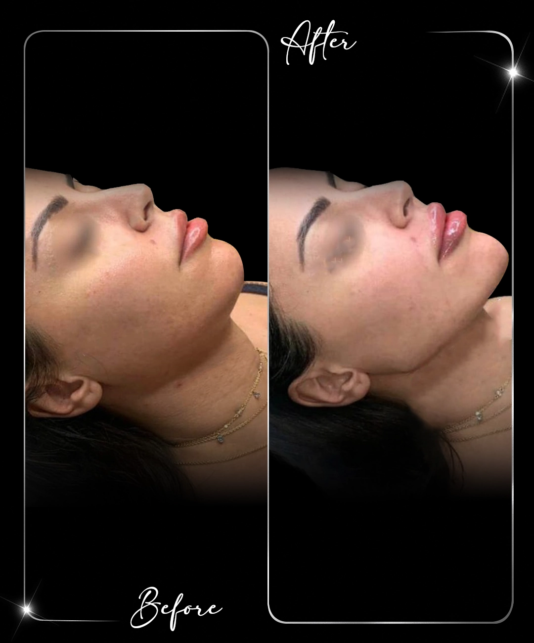 Jawline-Before-After-3