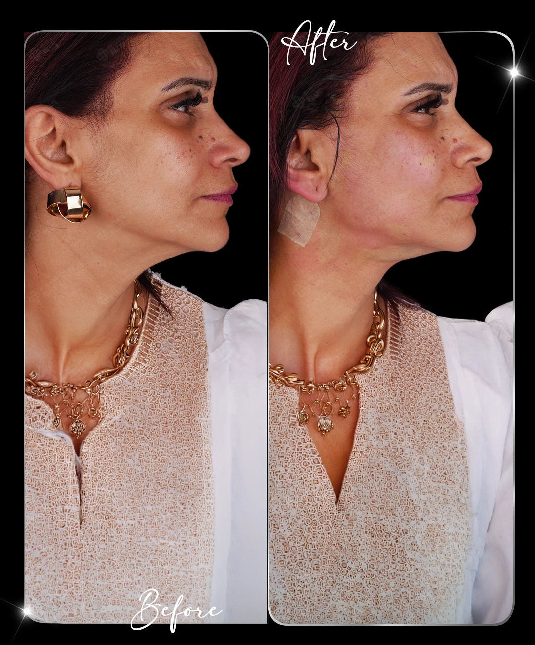 Jawline-Before-After-4