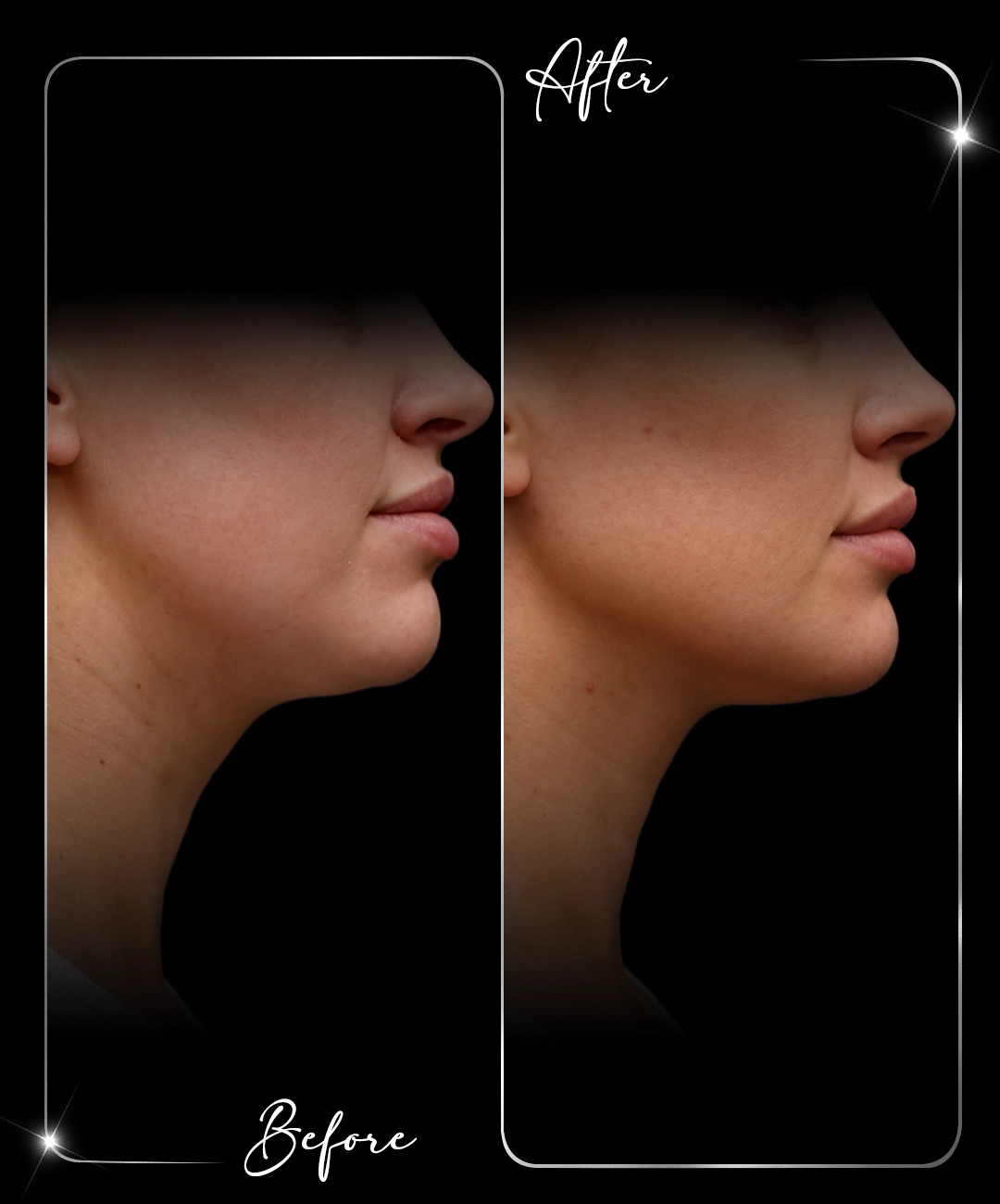 Jawline-Before-After-5