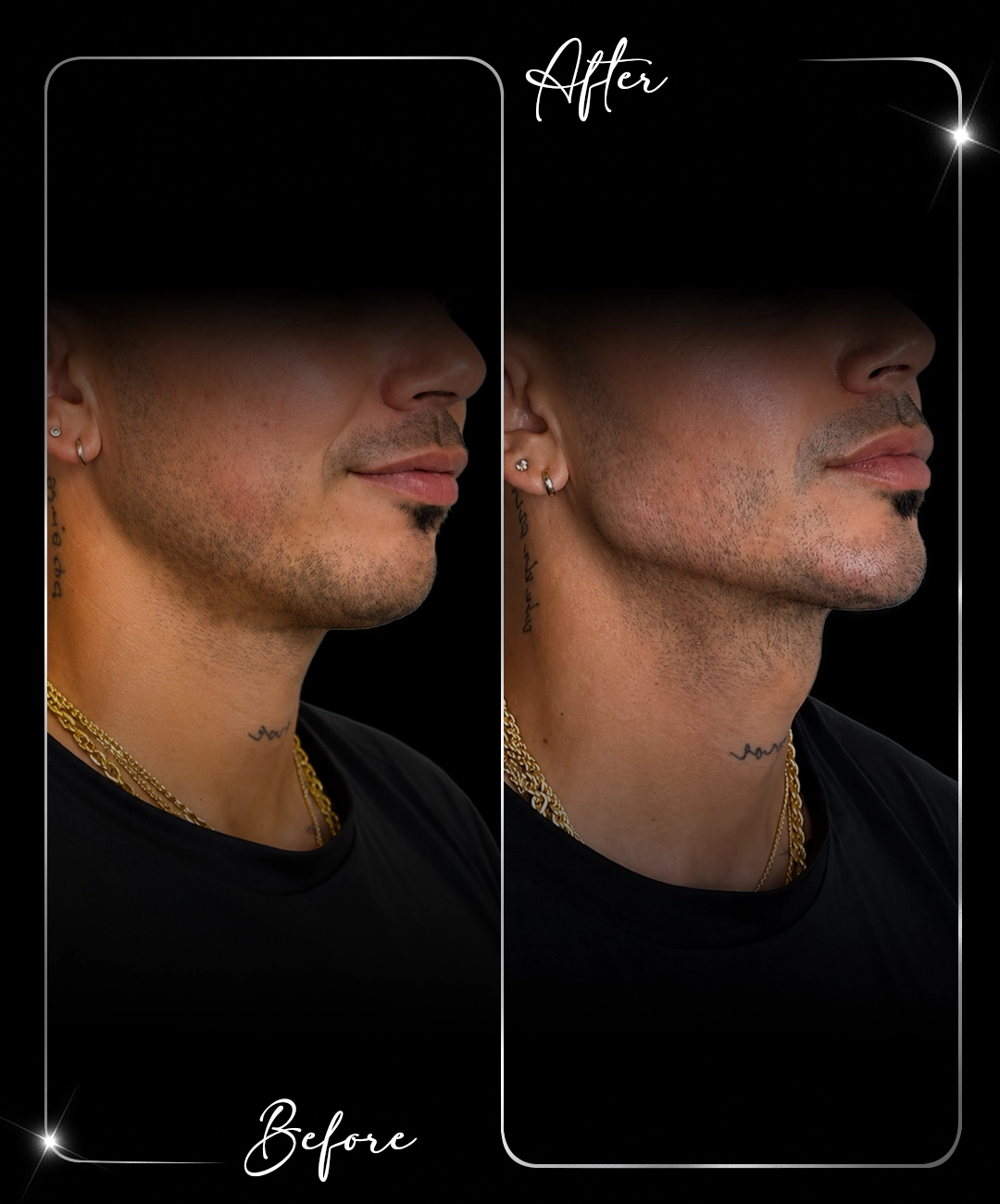 Jawline-Before-After-6