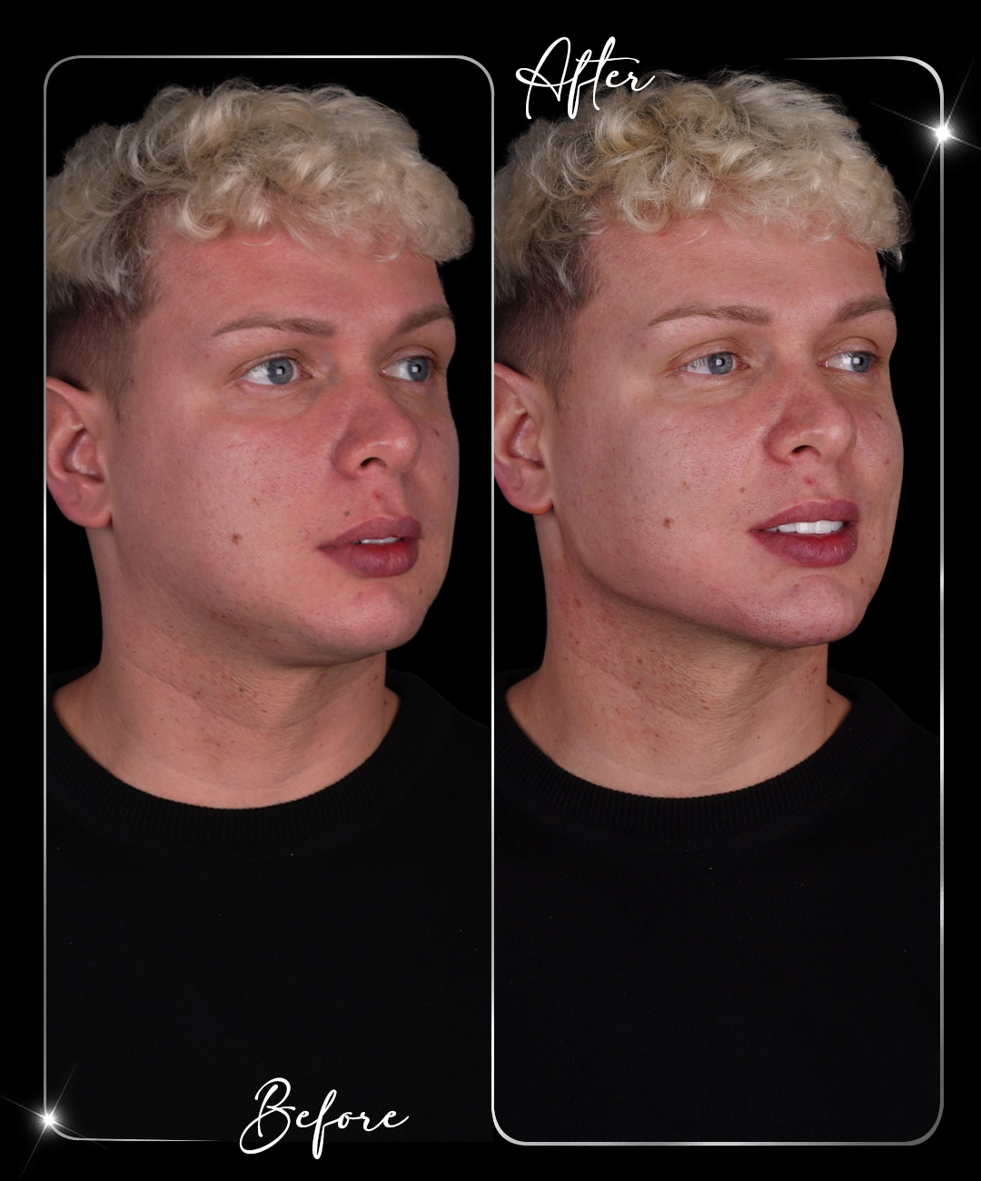 Jawline-Before-After-7