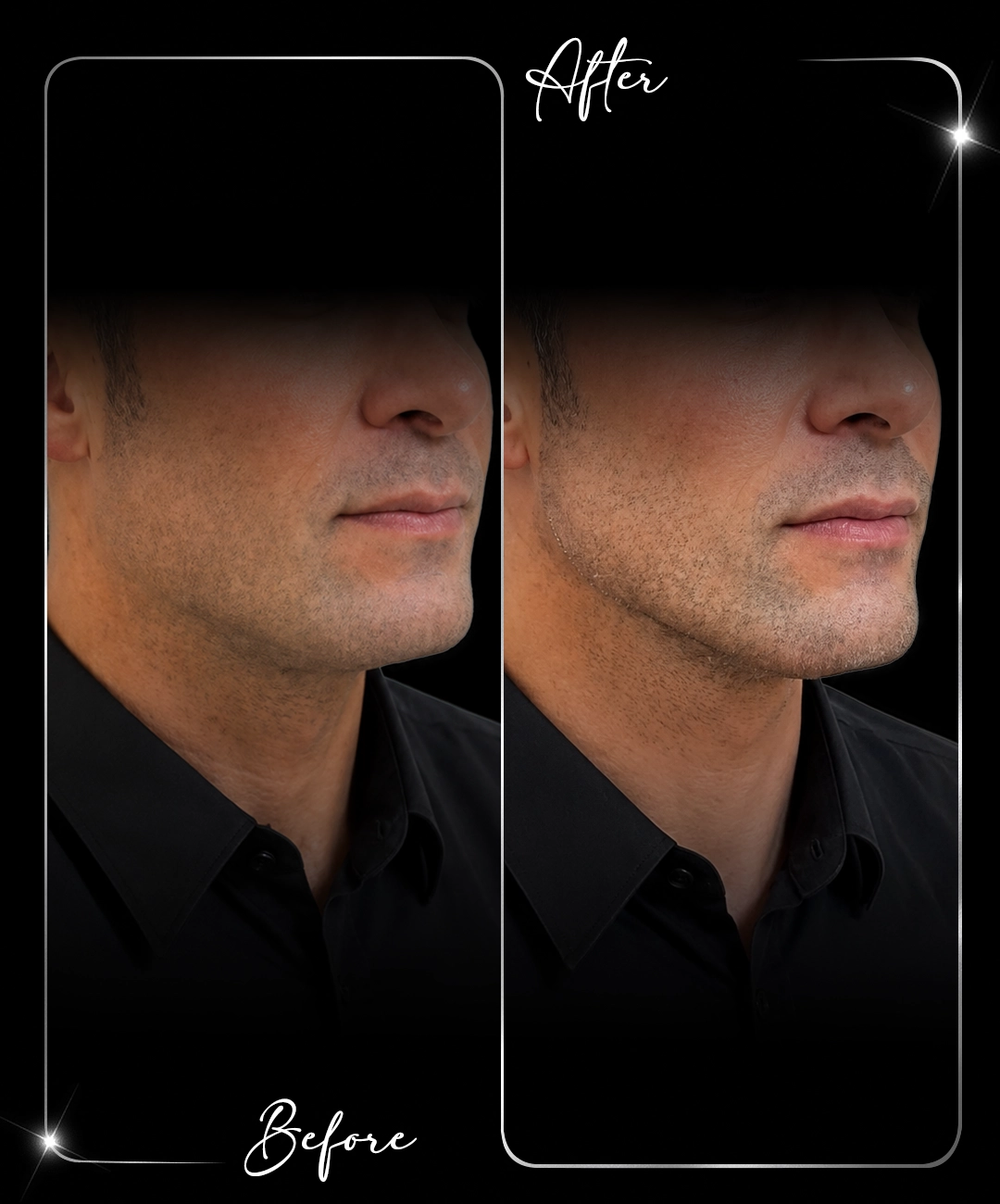 Jawline-Before-After-8