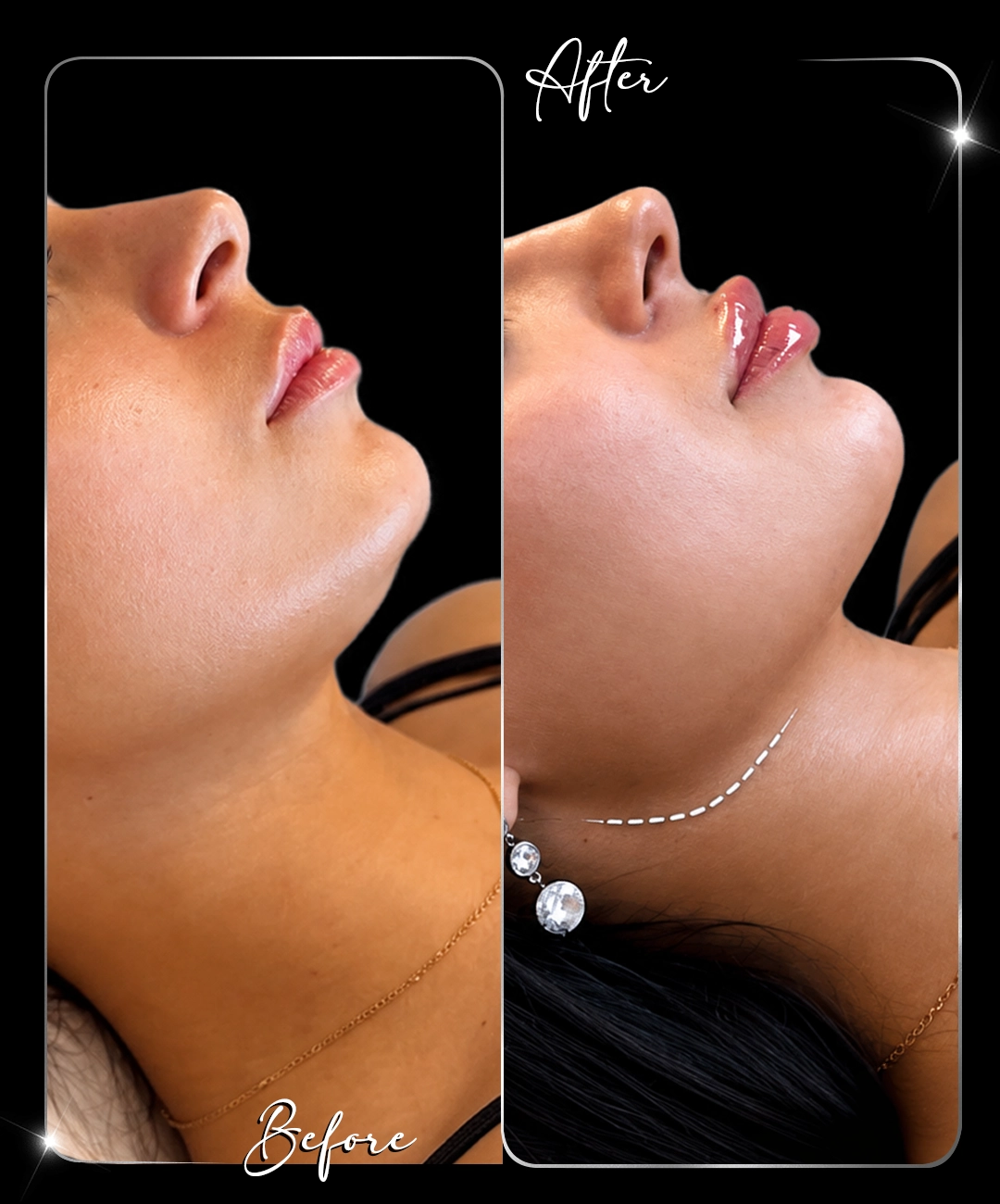 Jawline-Before-After-9