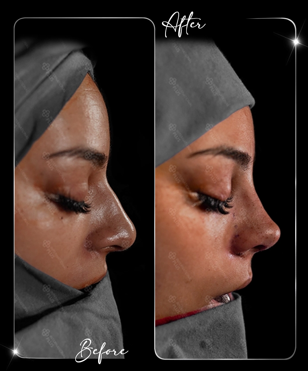Rhinoplasty-Before-After-1