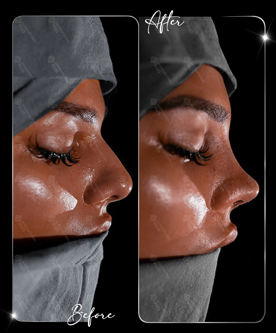 Rhinoplasty-Before-After-2