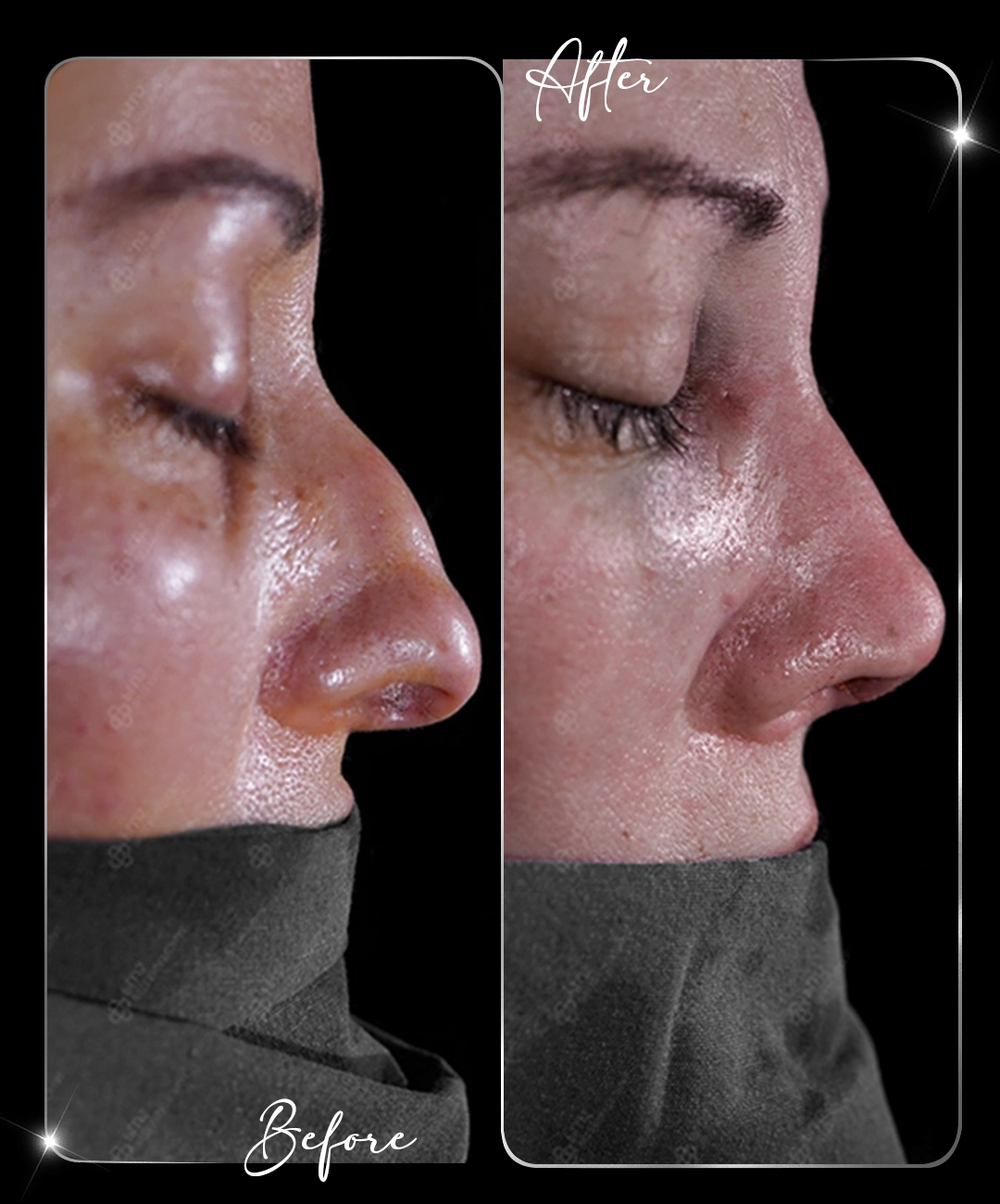 Rhinoplasty-Before-After-3