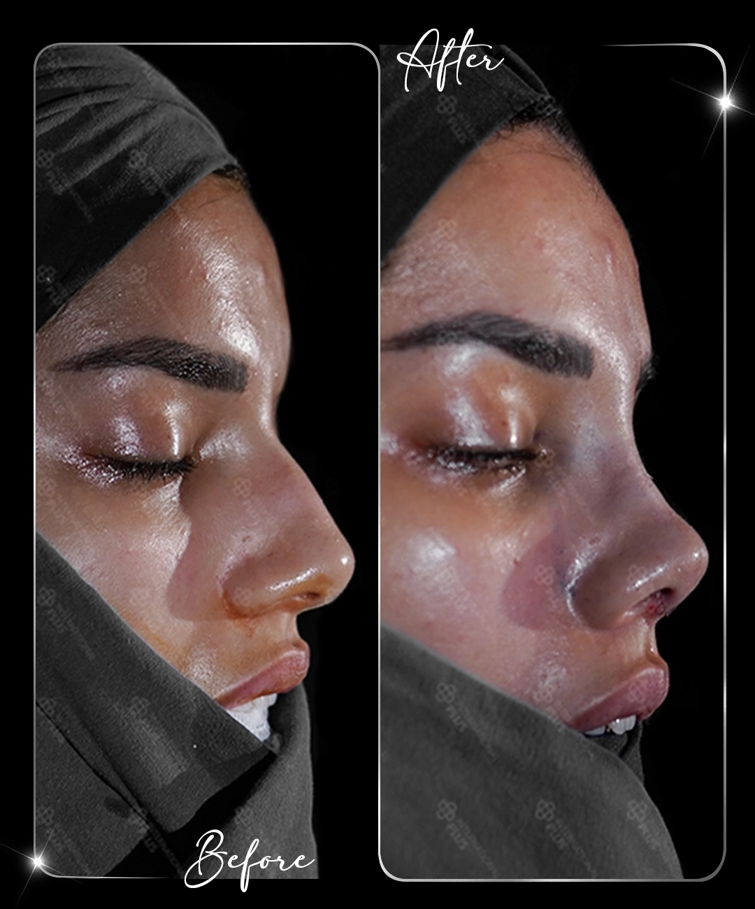 Rhinoplasty-Before-After-4