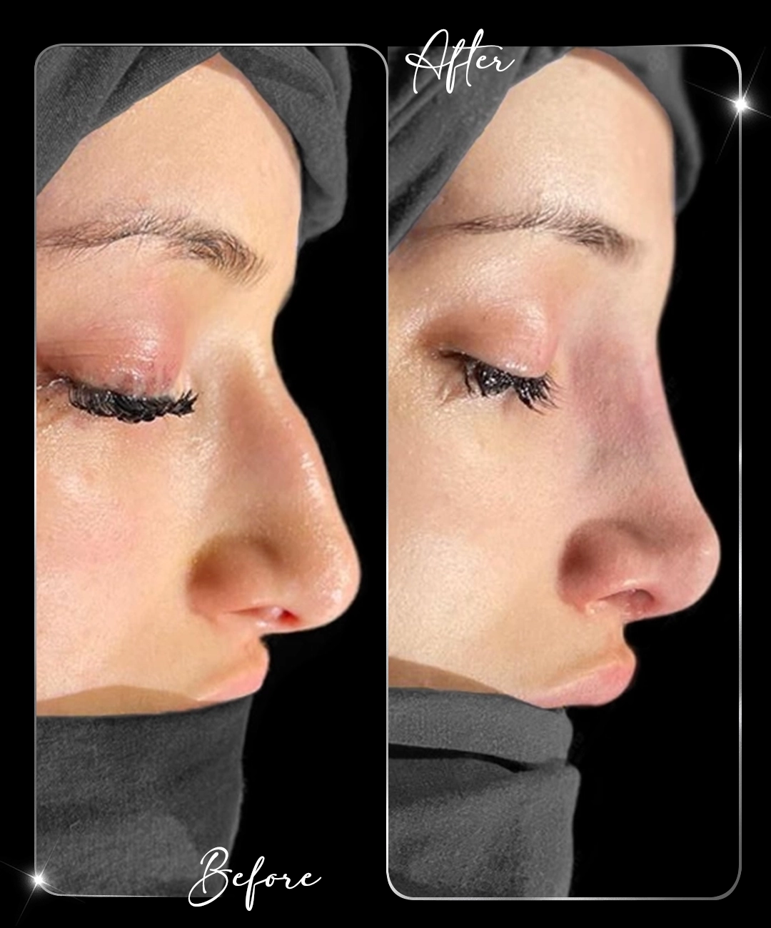 Rhinoplasty-Before-After-5